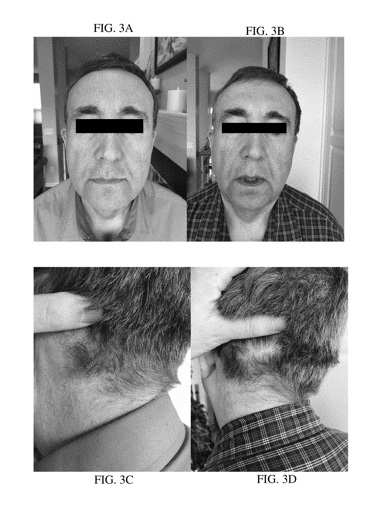 Treatment of psoriasis, seborrheic dermatitis, and eczema of the head and neck