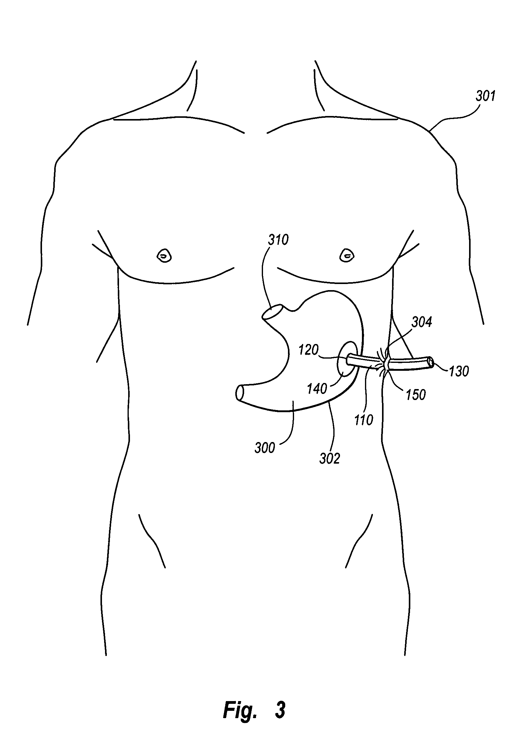 Medical devices and methods of use