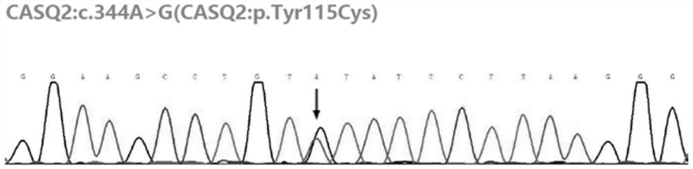 Mutant hereditary arrhythmia gene and application thereof