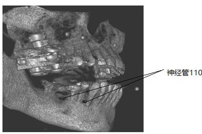 A needle-assisted navigation and early warning method, device, and surgical robot