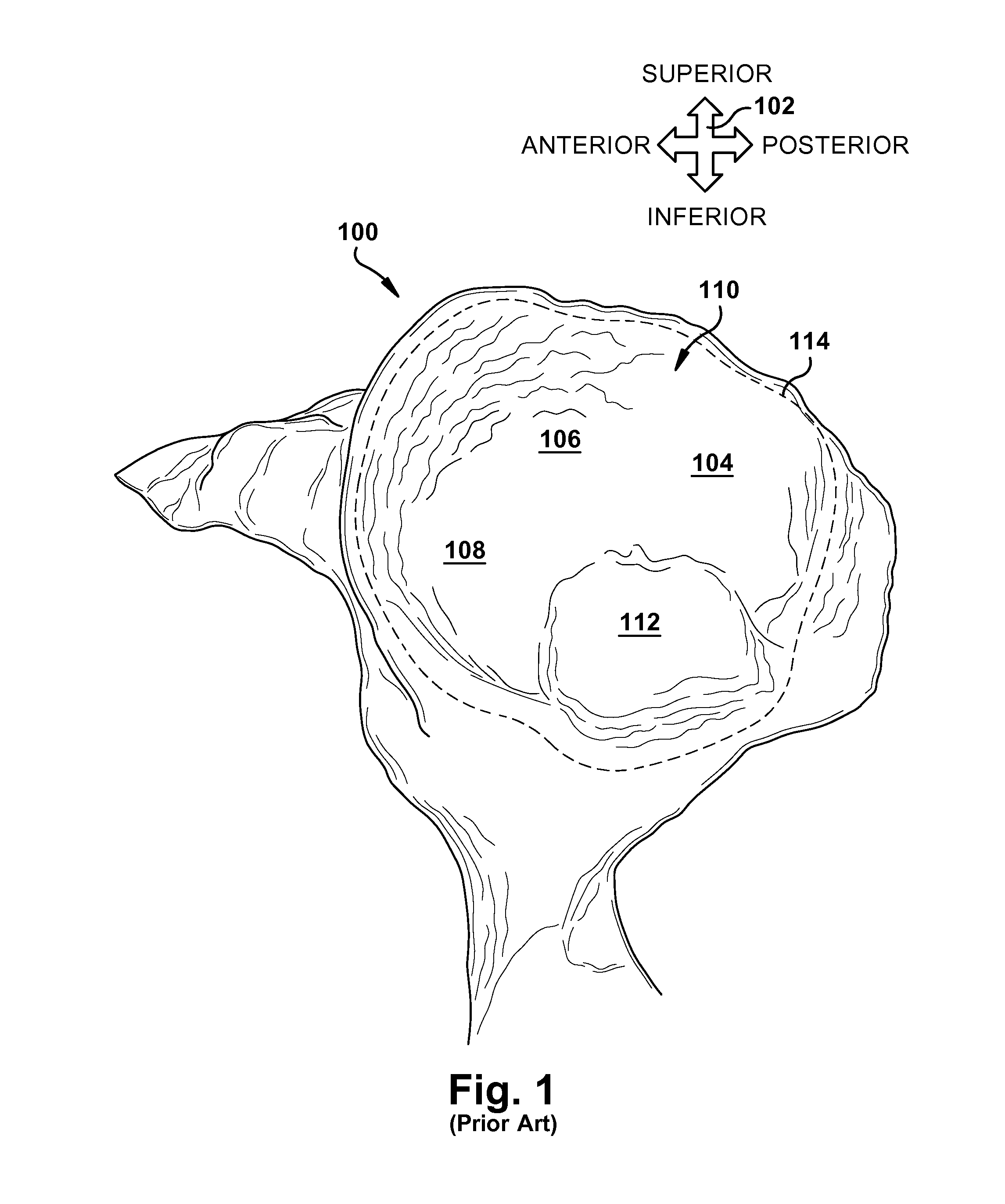 System and method for assisting with attachment of a stock implant to a patient tissue