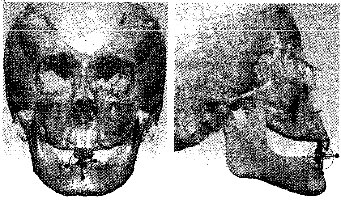 A Digital Alignment Method Based on Tooth Root Information