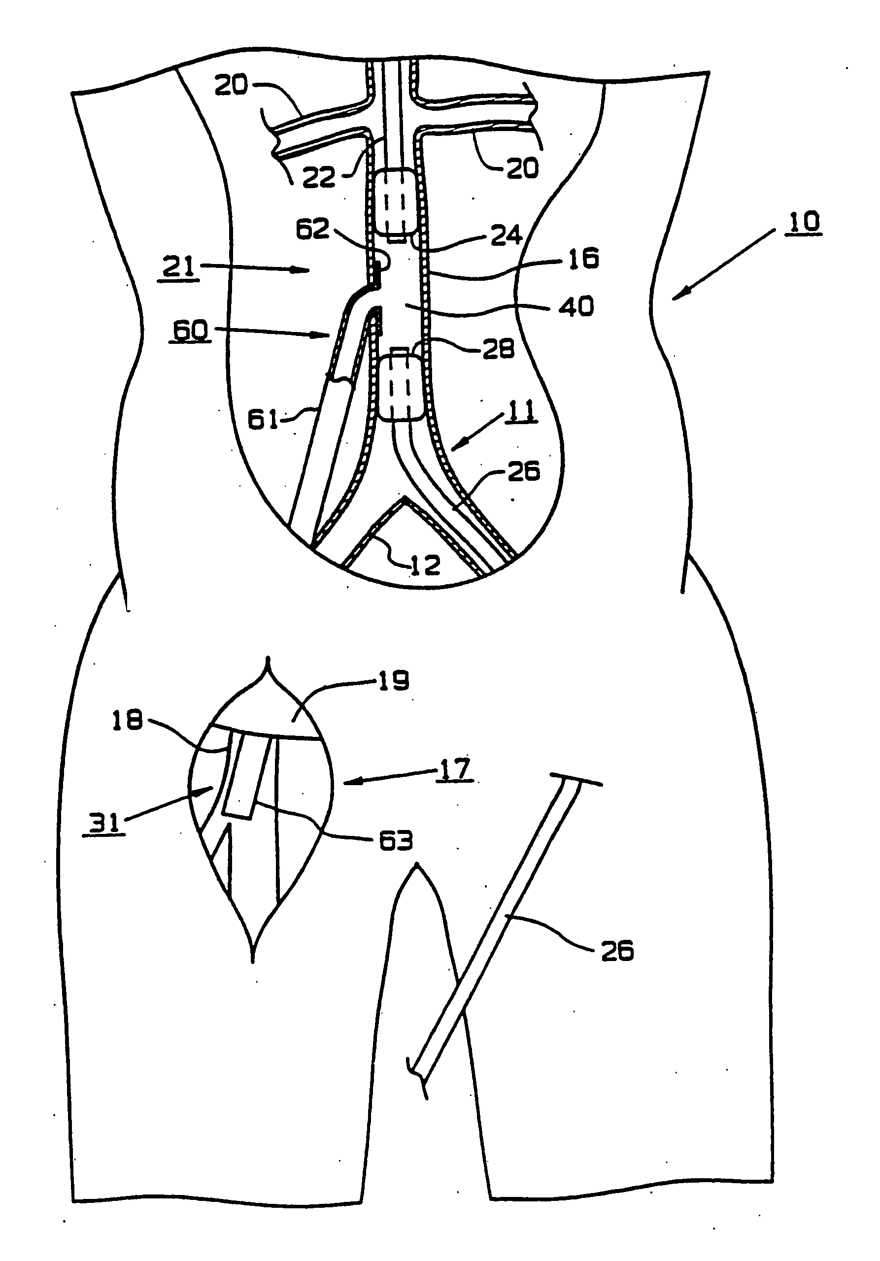 Graft implant method