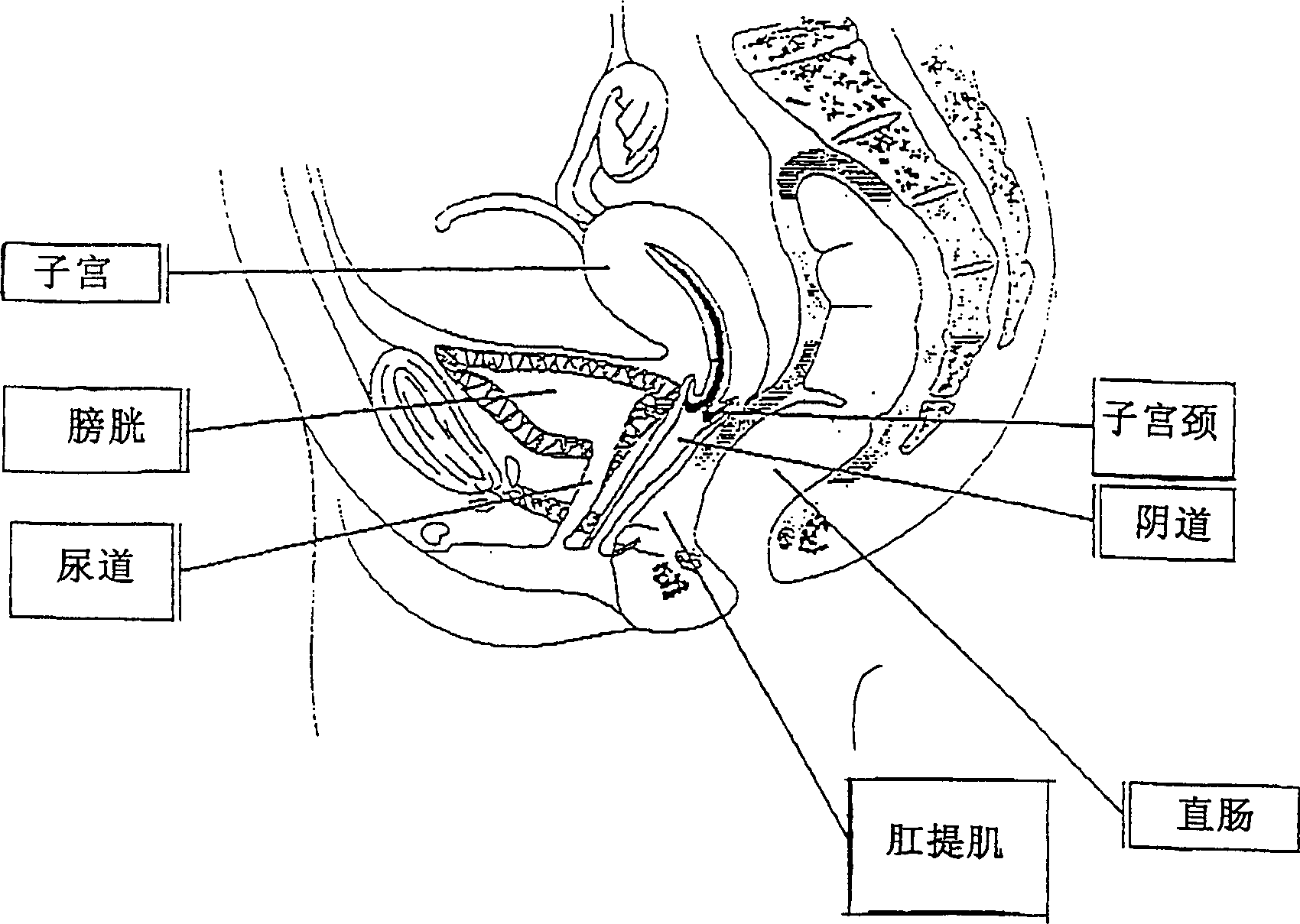 Device of treating prolapse of urogenital organ and urinary stress incontinence in women