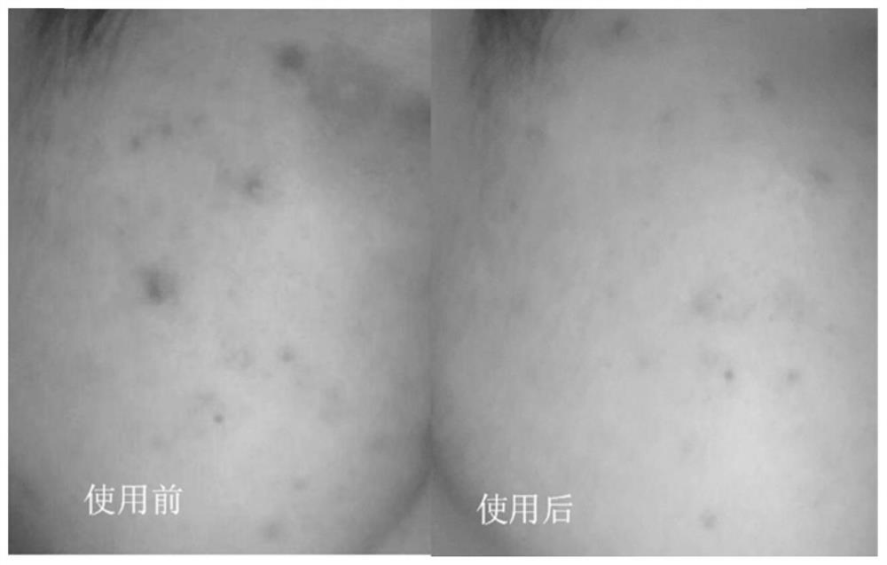 Composition for treating acne, preparation method therefor and application of composition