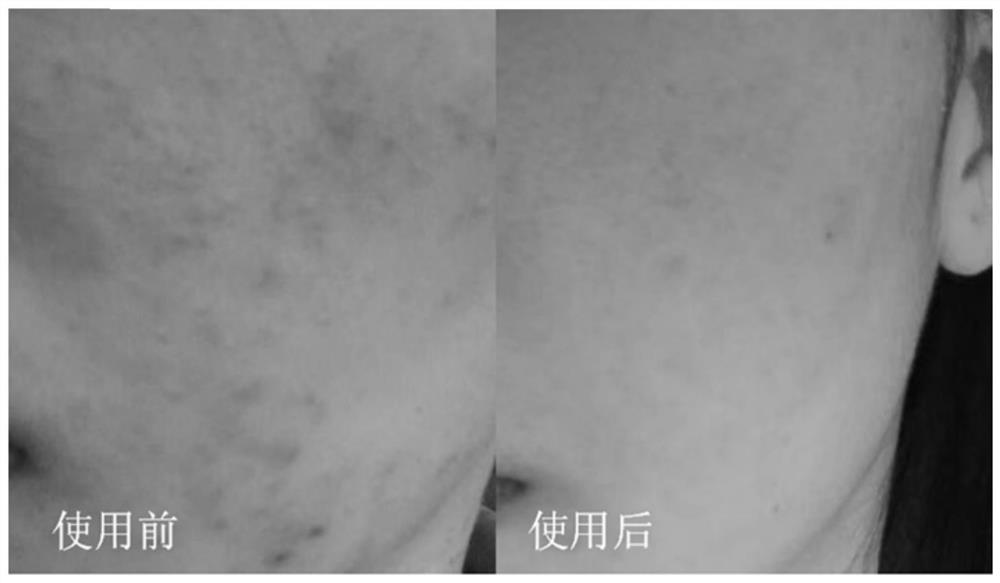 Composition for treating acne, preparation method therefor and application of composition