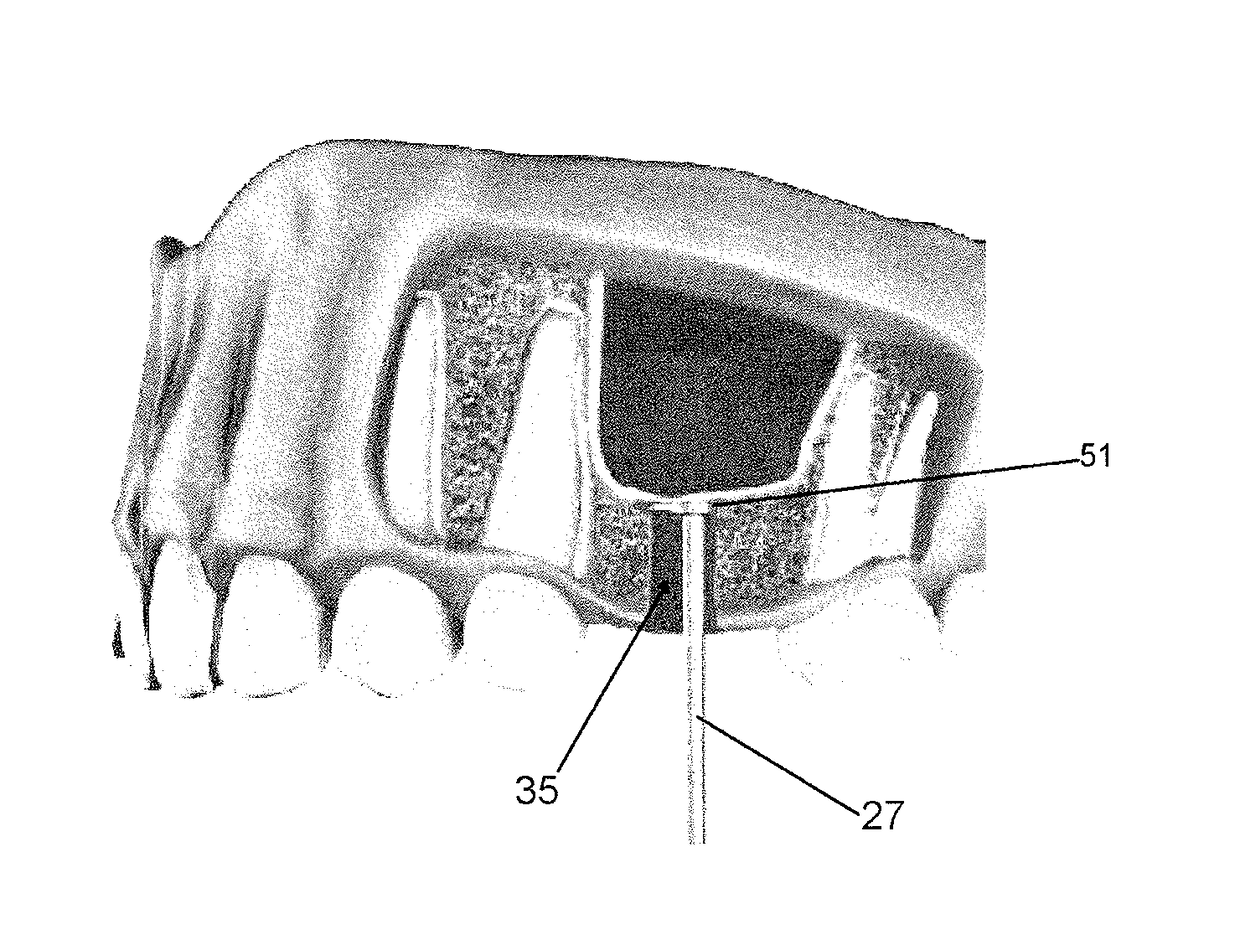 Sinus lift procedure and sidecutting drill