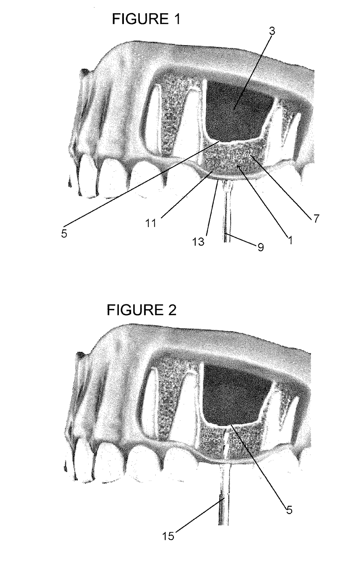 Sinus lift procedure and sidecutting drill