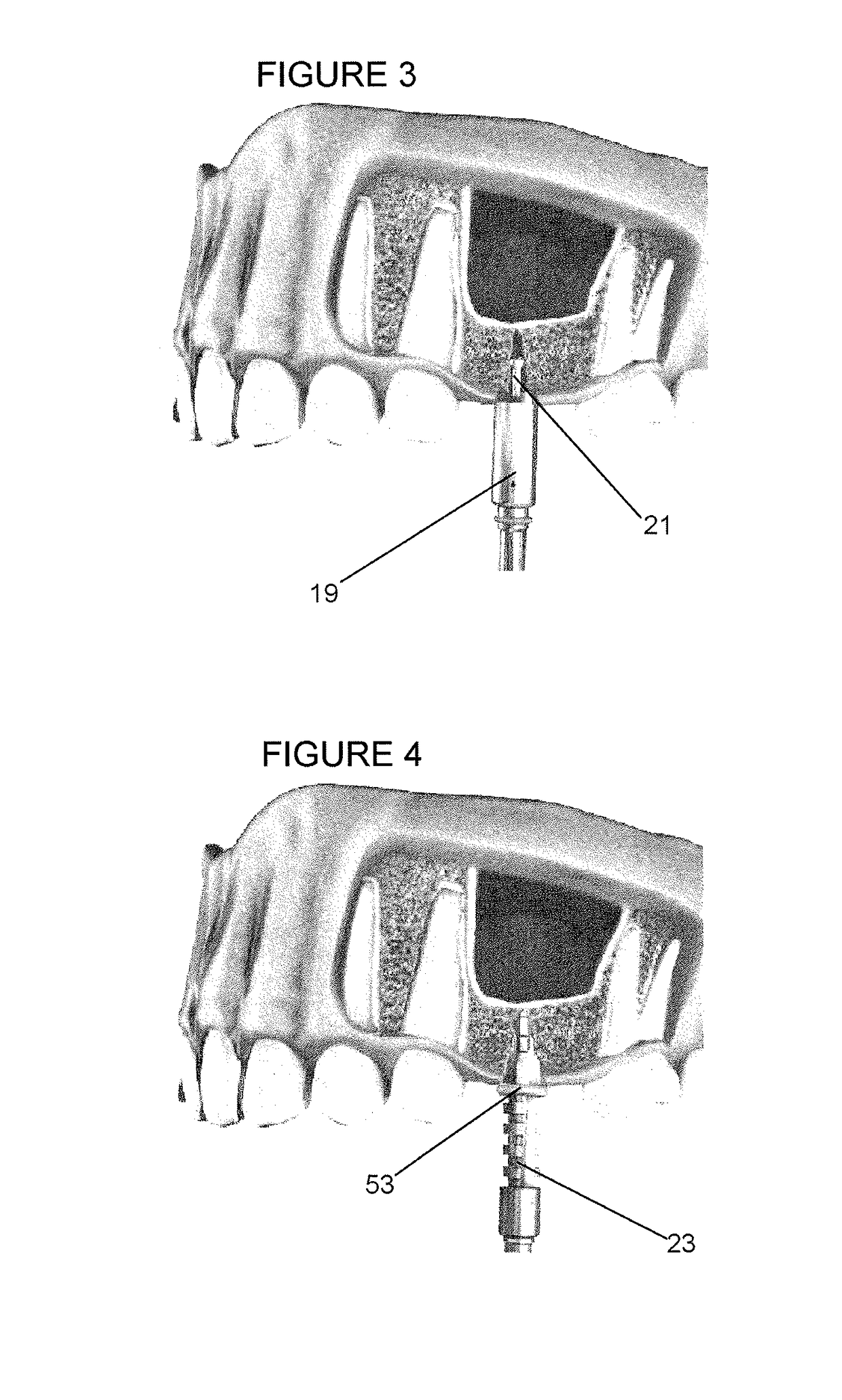 Sinus lift procedure and sidecutting drill