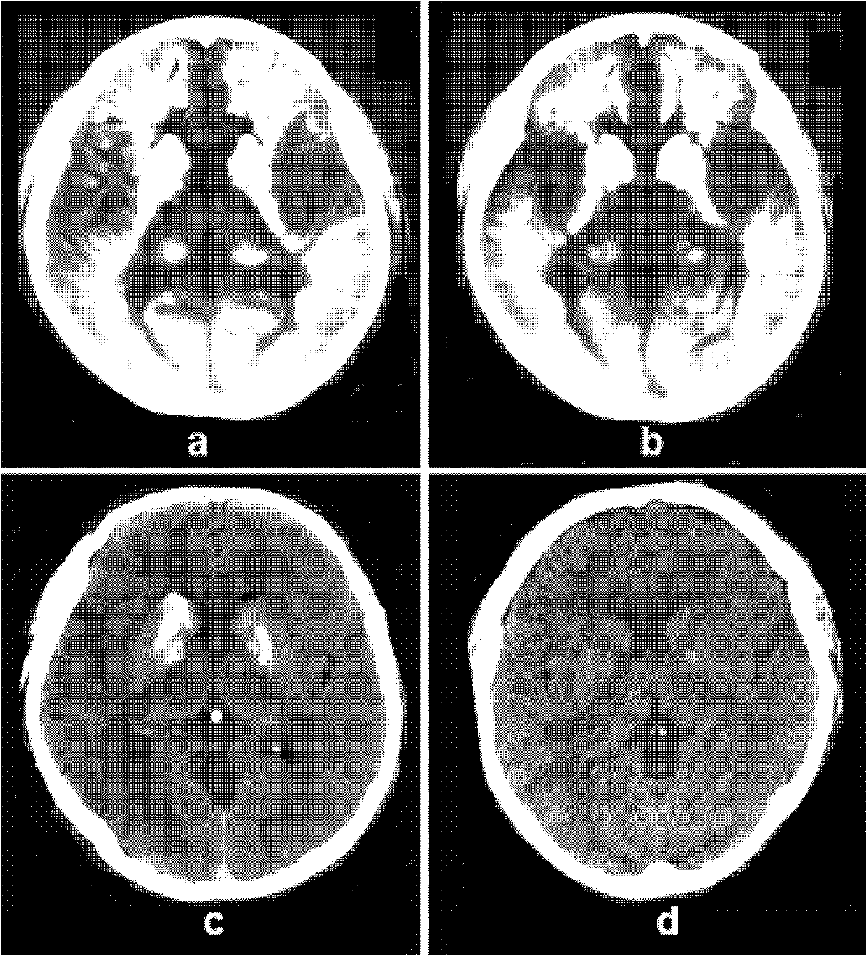Human idiopathic basal ganglia calcification disease-causing gene and coding protein thereof
