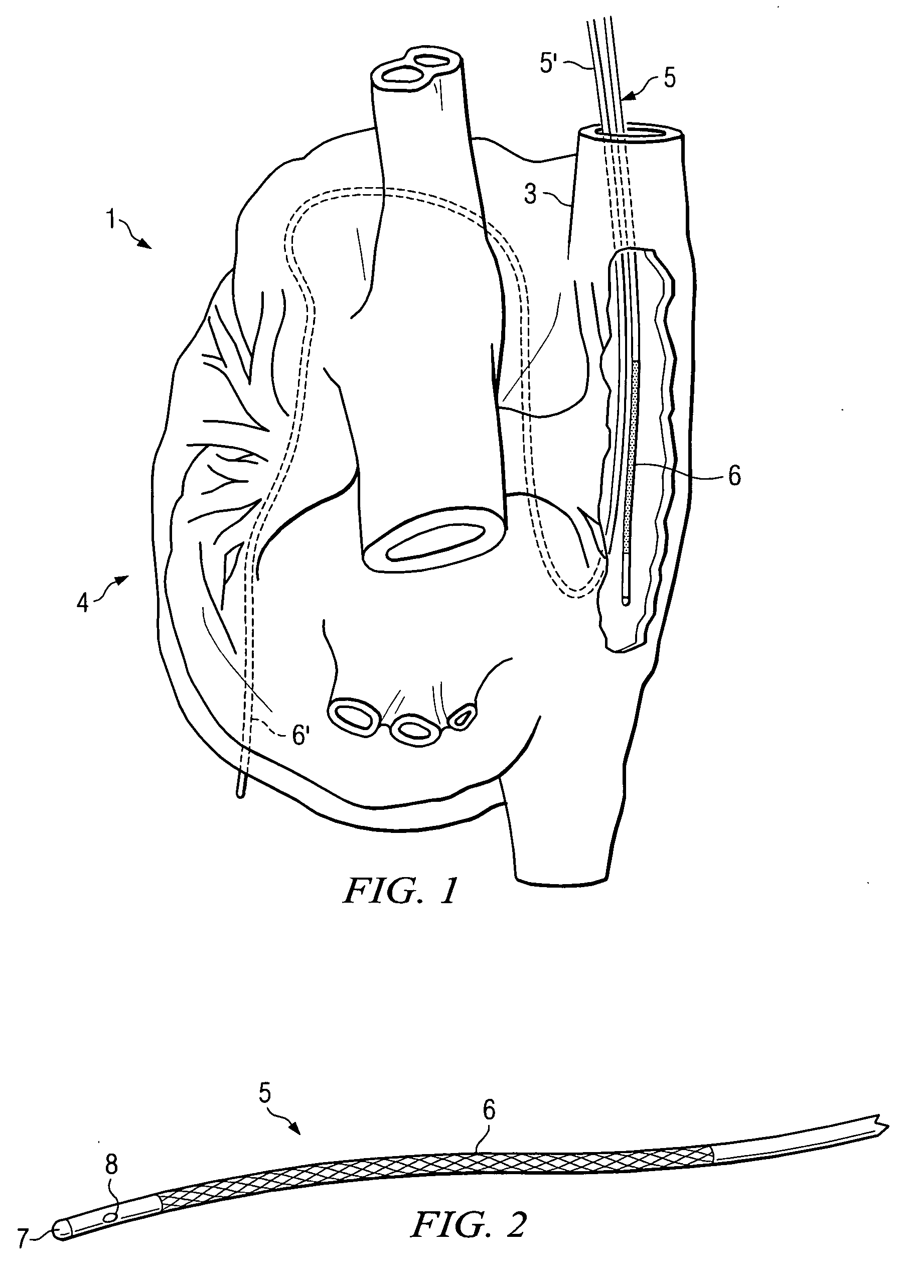 Apparatus and method for guiding catheters
