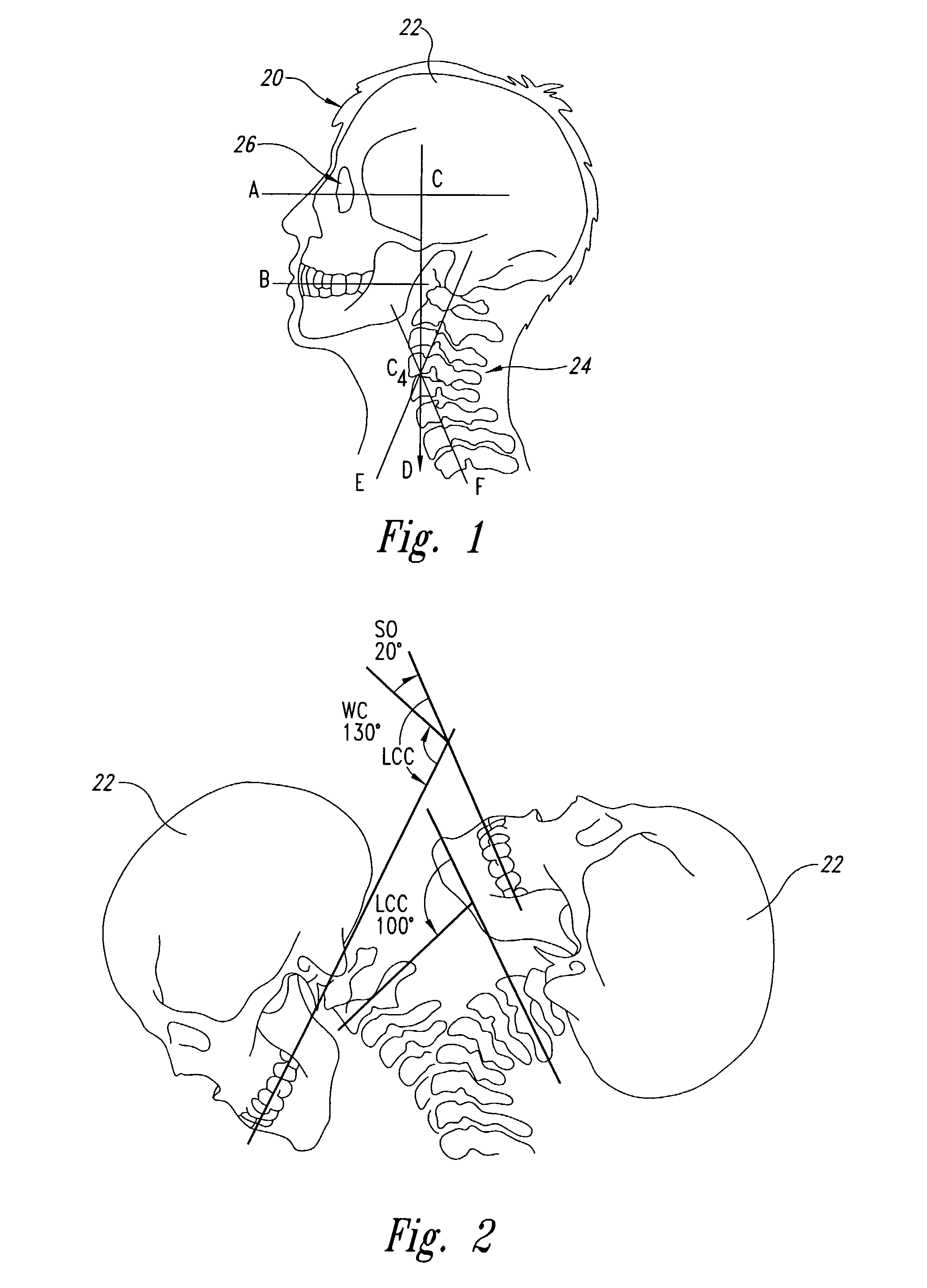 Spinal adjusting device and method