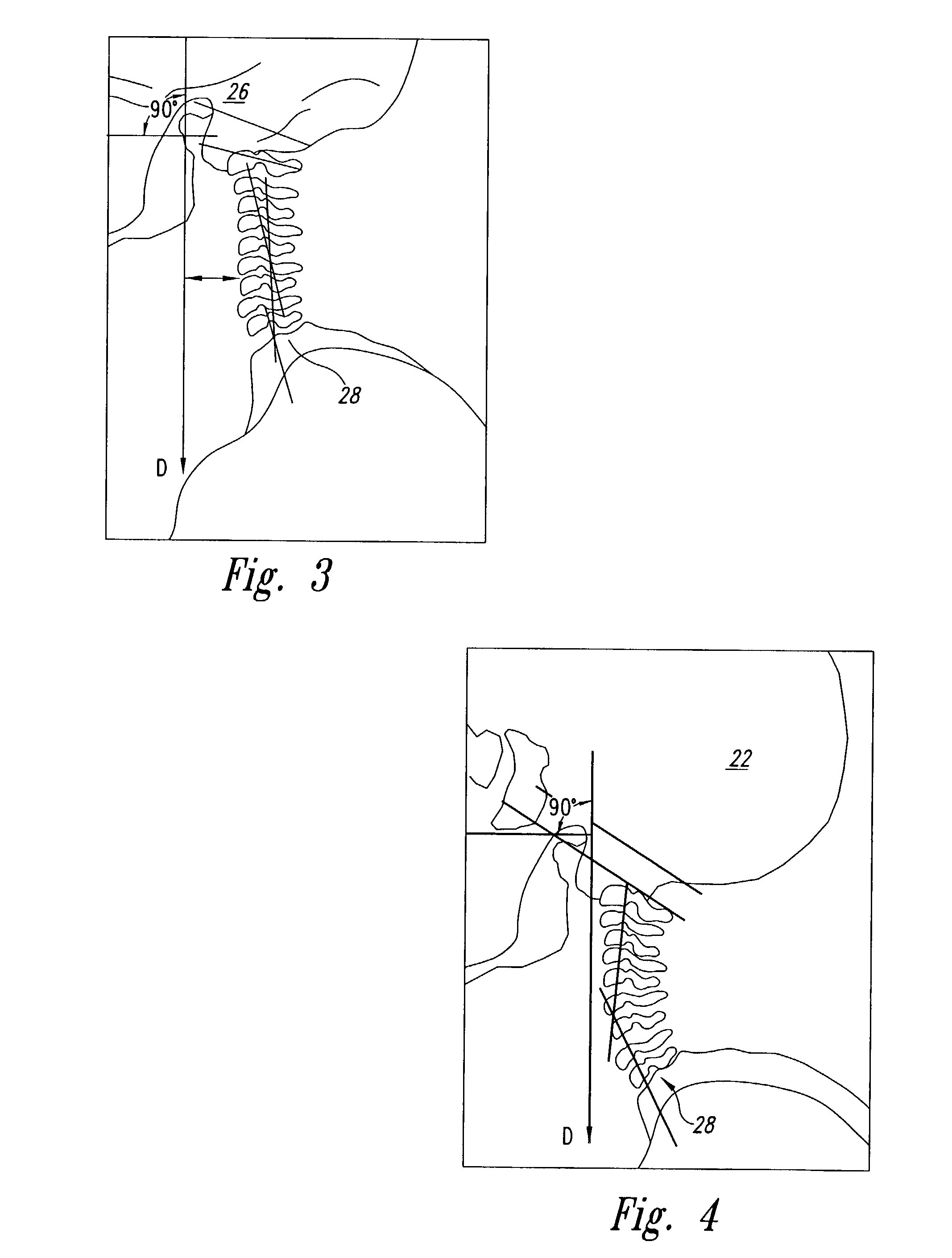 Spinal adjusting device and method