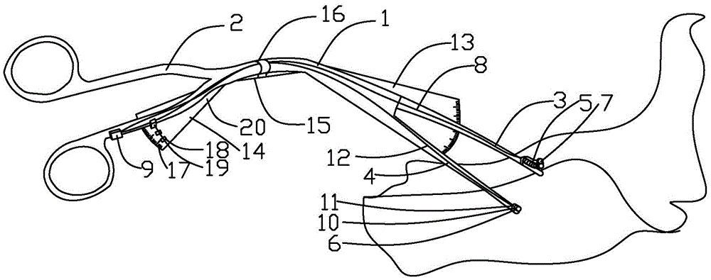 Trachea cannula pliers