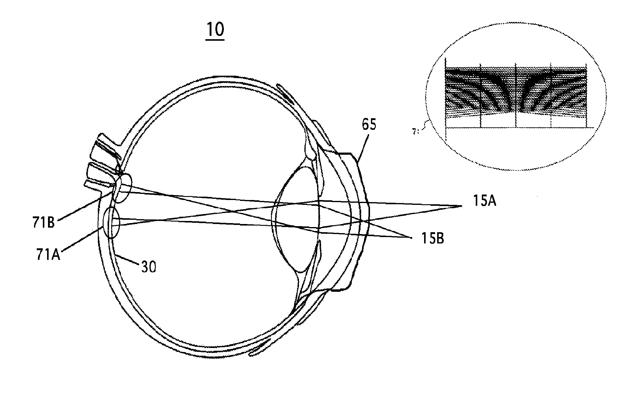 Extended Depth Field Optics With Variable Pupil Diameter
