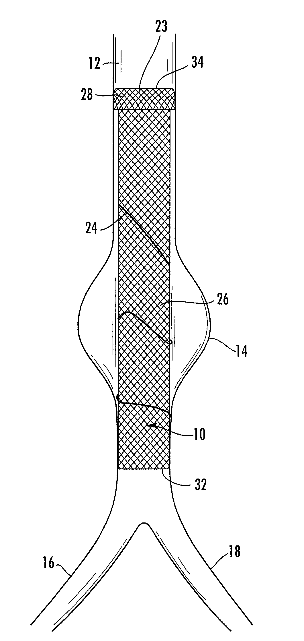 Stent/stent graft for reinforcement of vascular abnormalities and associated method