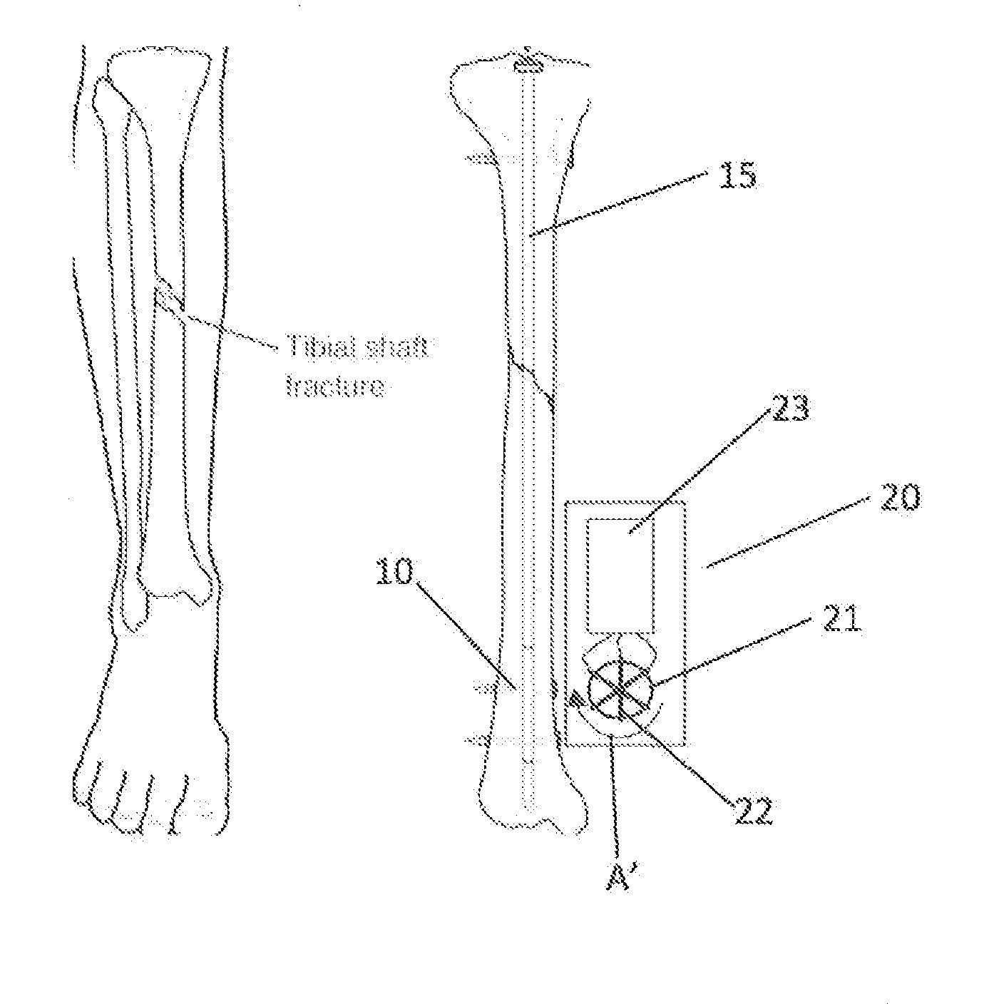 Dynamic force generation for bone repair