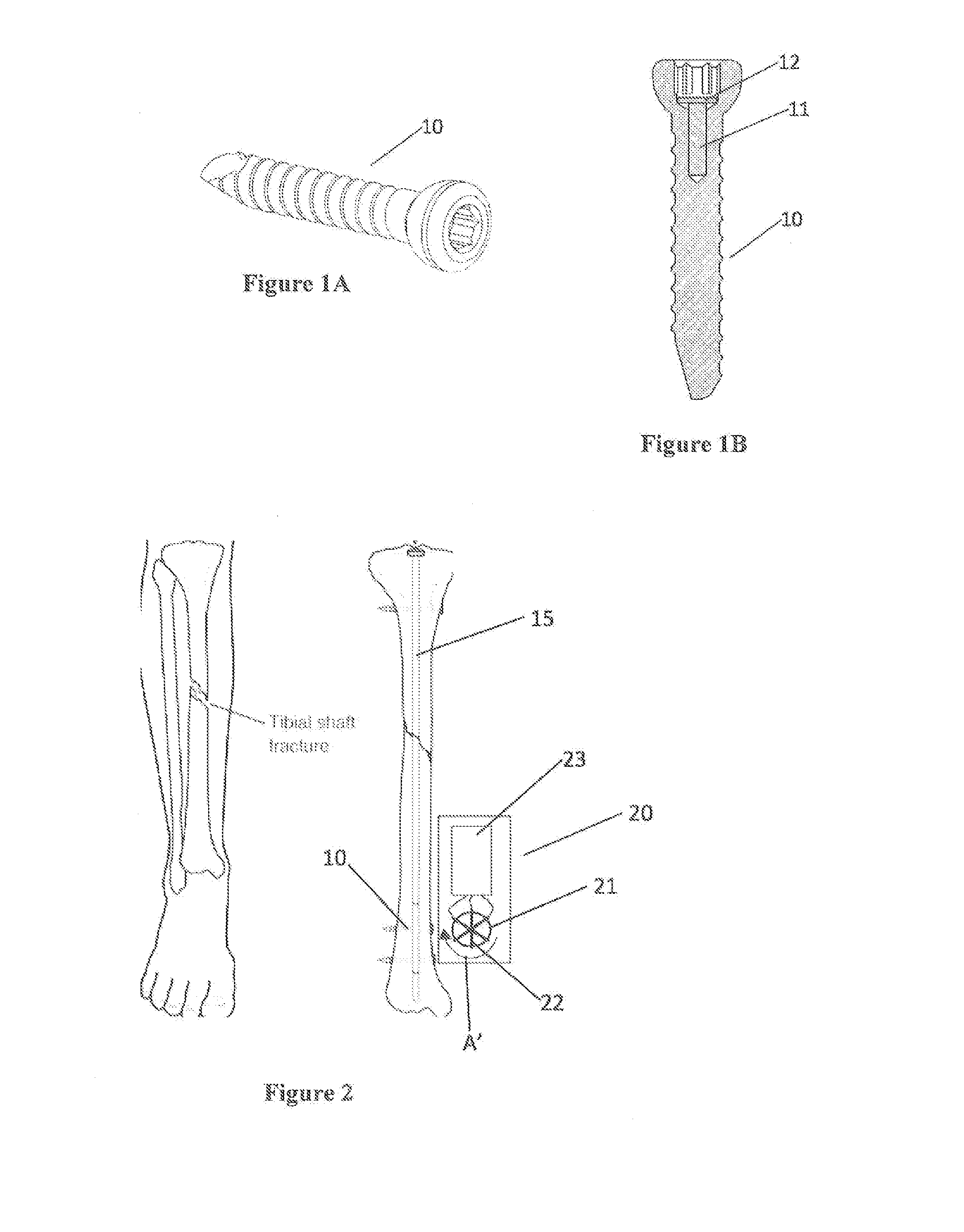 Dynamic force generation for bone repair