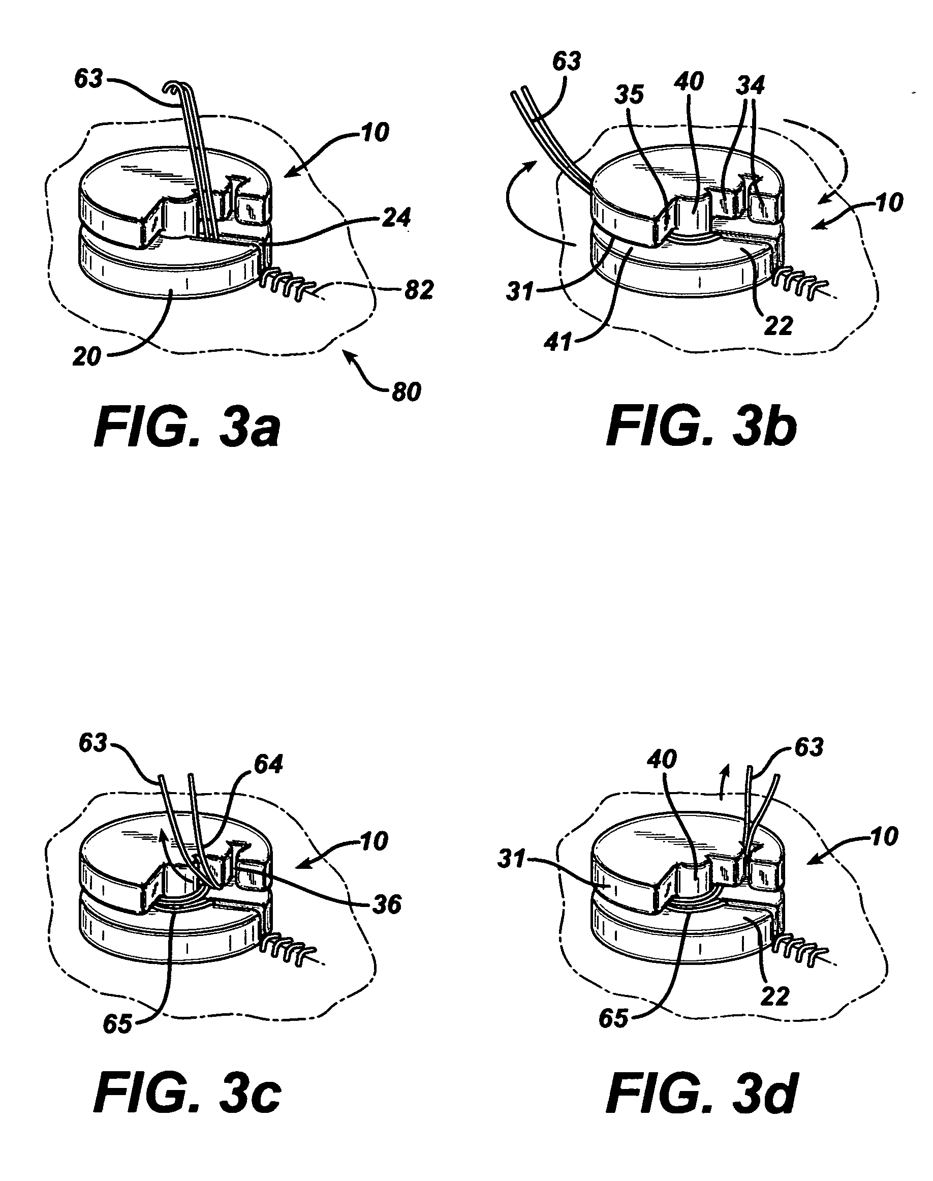 Suture anchoring device