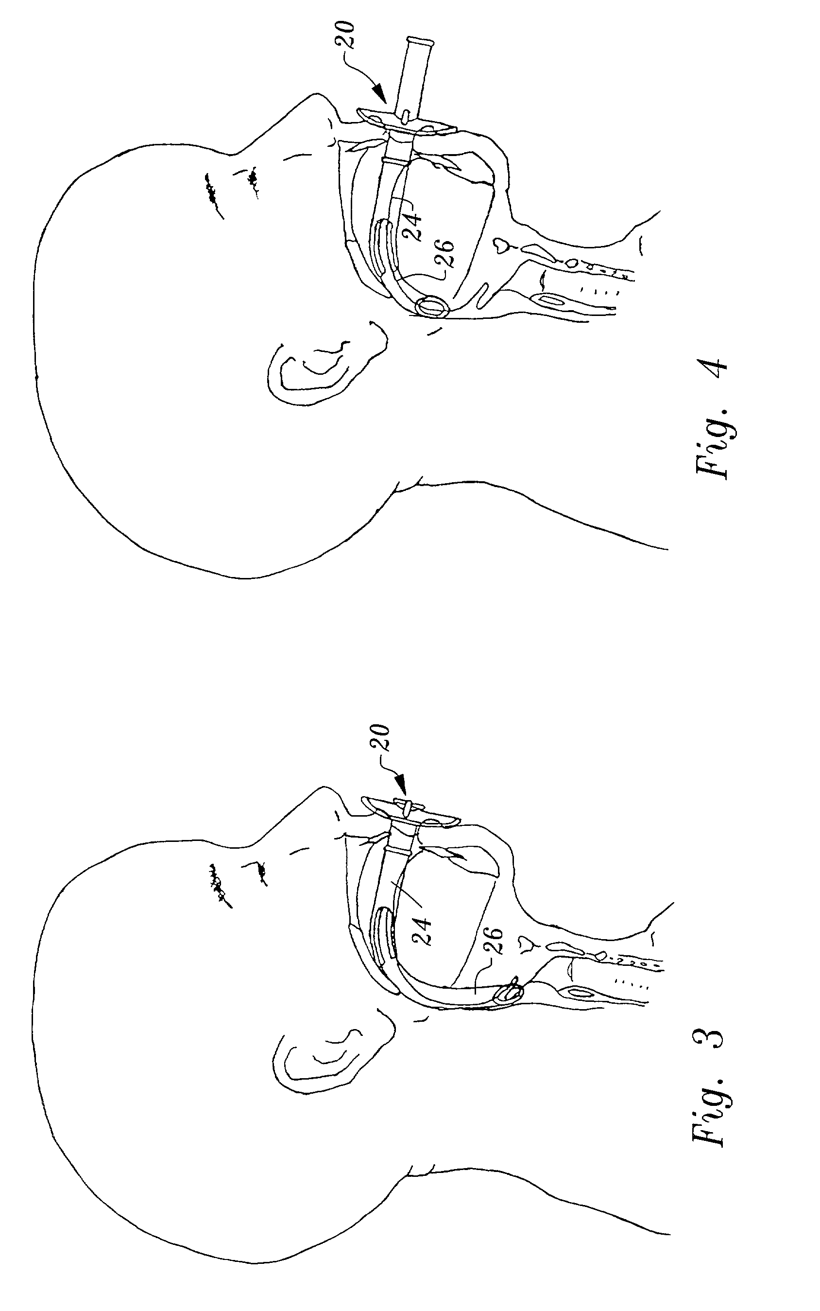 Adjustable oropharyngeal airway apparatus