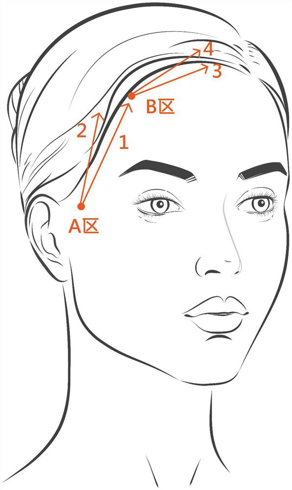 Beauty injection method for lifting, firming and shaping face on hairline