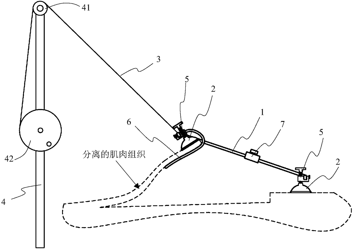 Muscle traction device