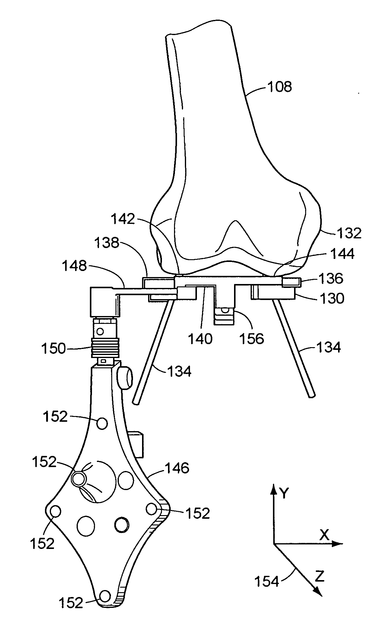 System and method for bone resection