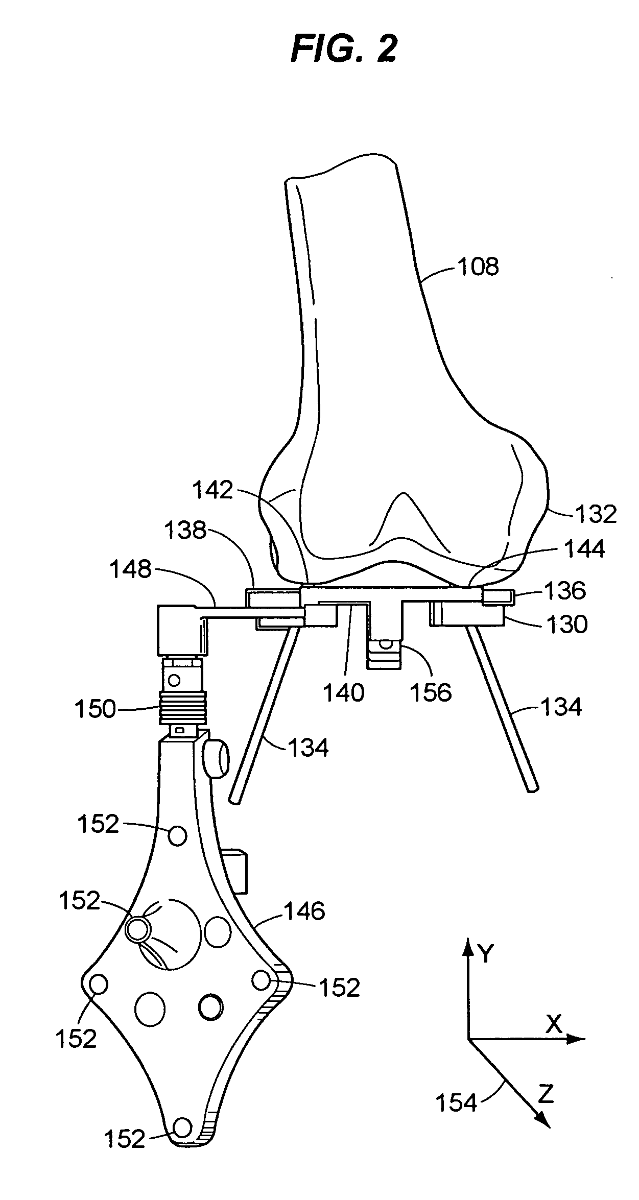 System and method for bone resection
