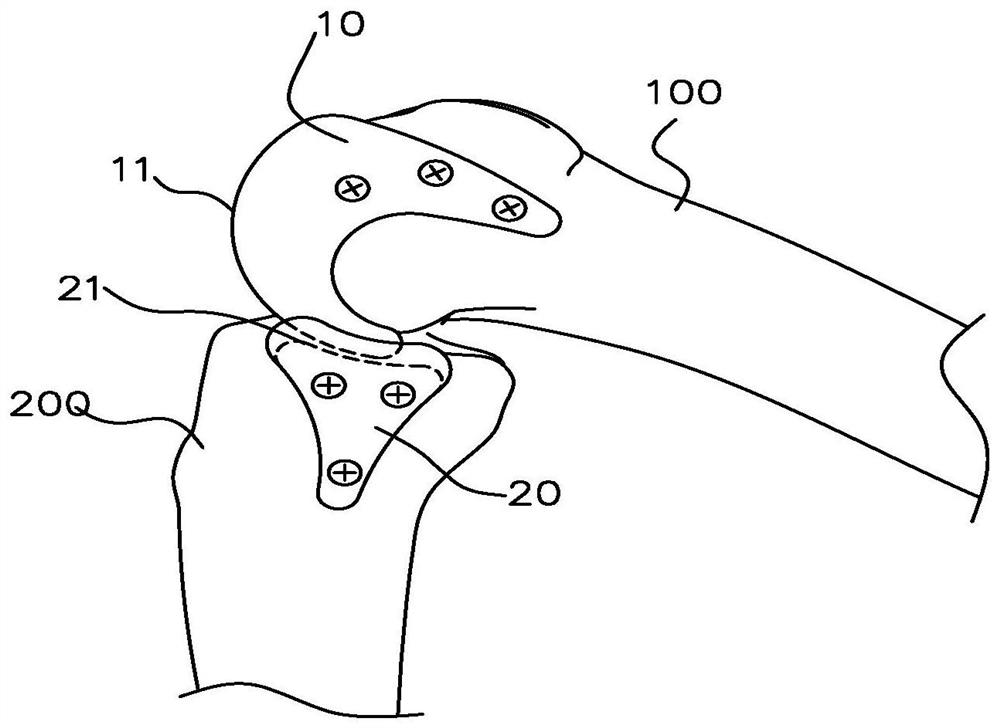 Knee joint load reducing device