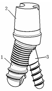 Bionic dental implant and abutment and seminal root thereof