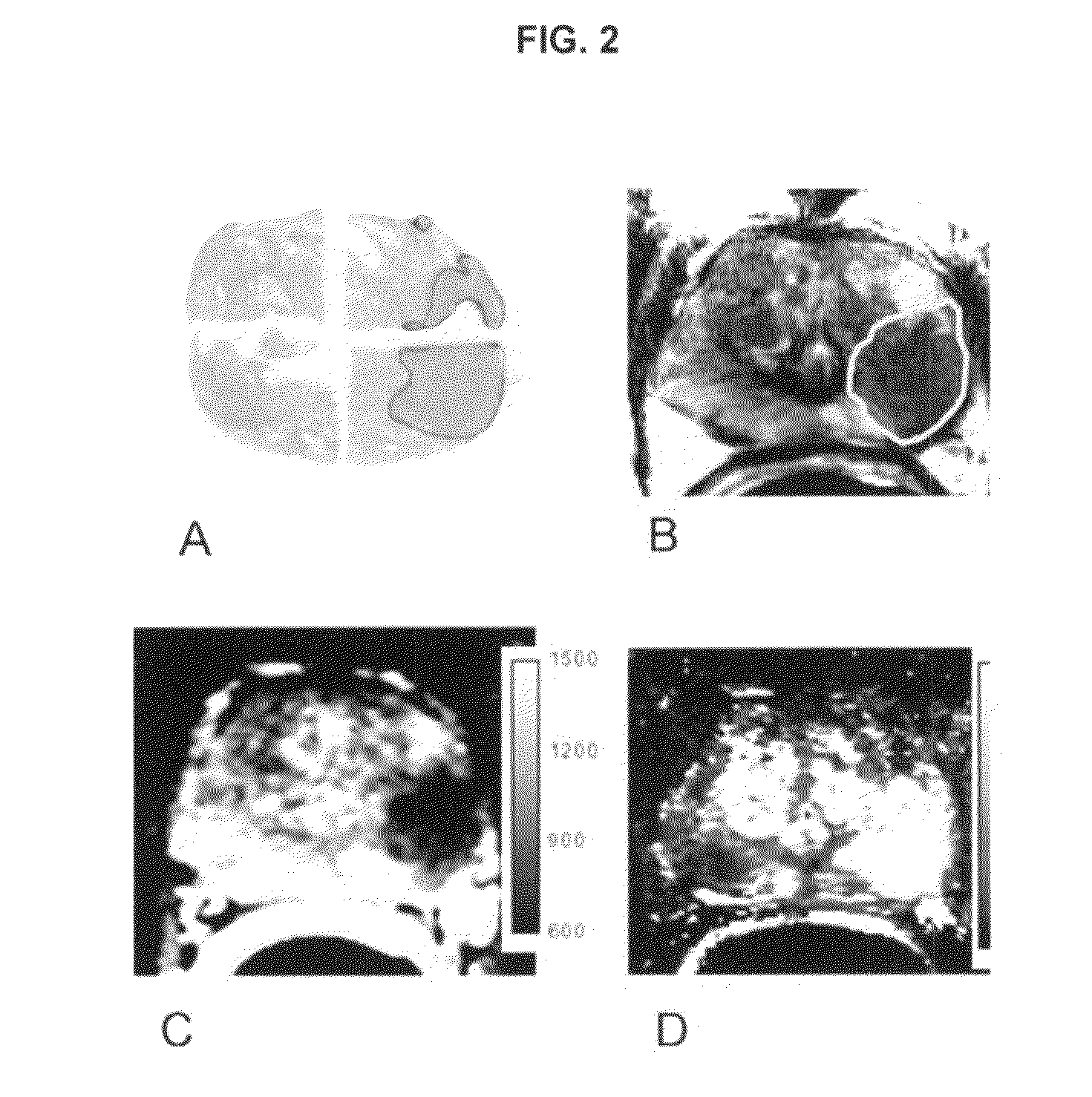 System and method of guided treatment within malignant prostate tissue