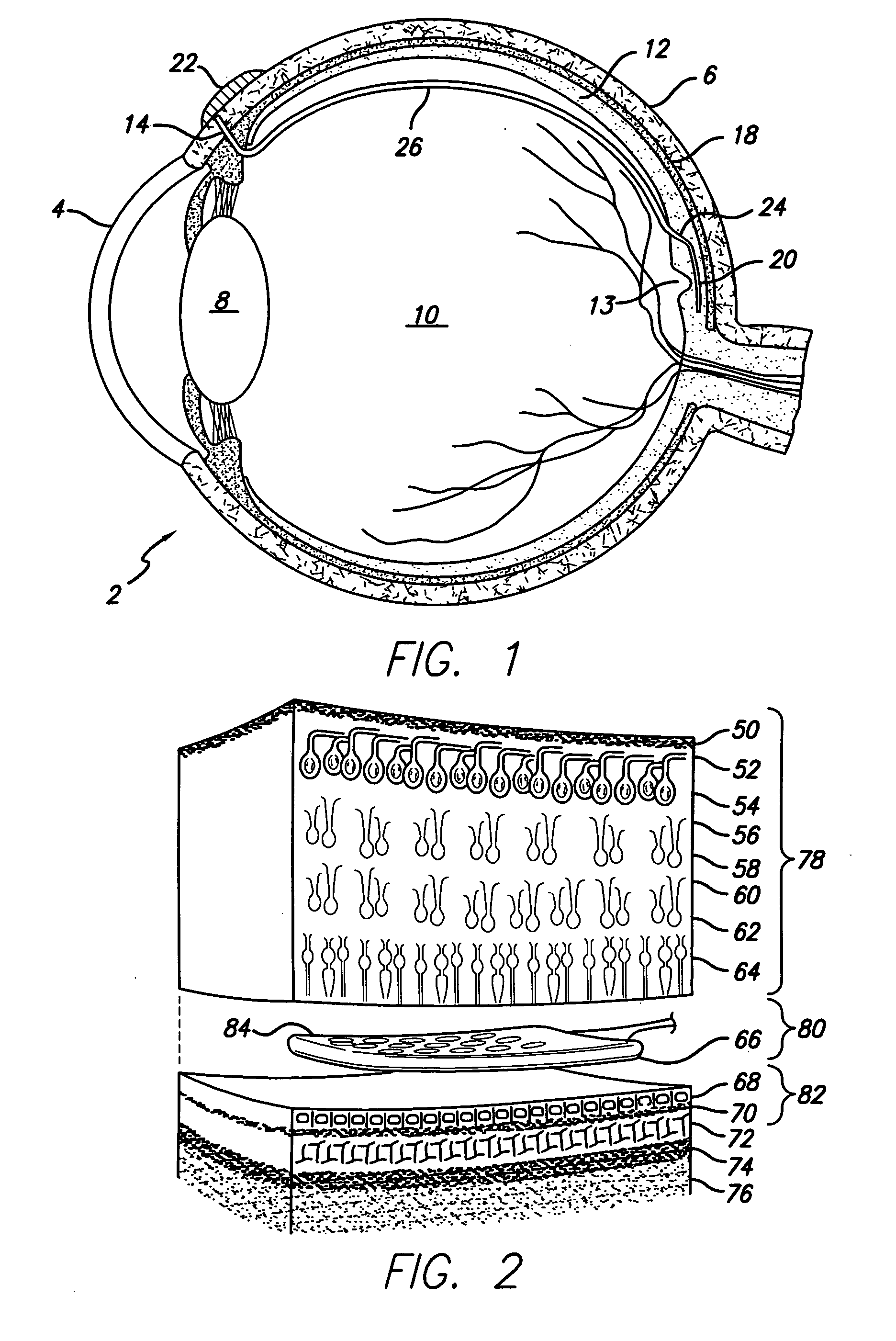 Transretinal implant and method of manufacture