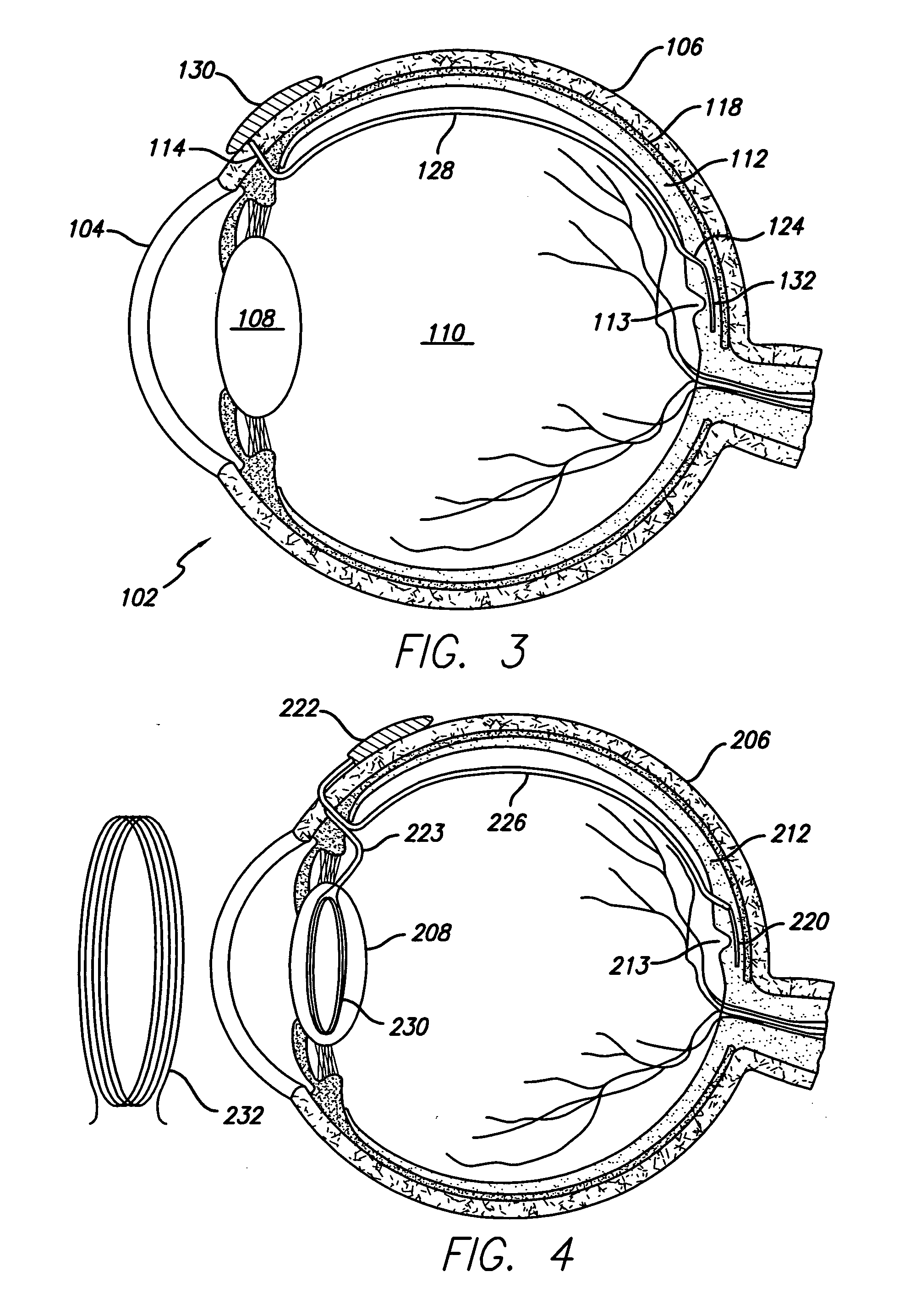 Transretinal implant and method of manufacture