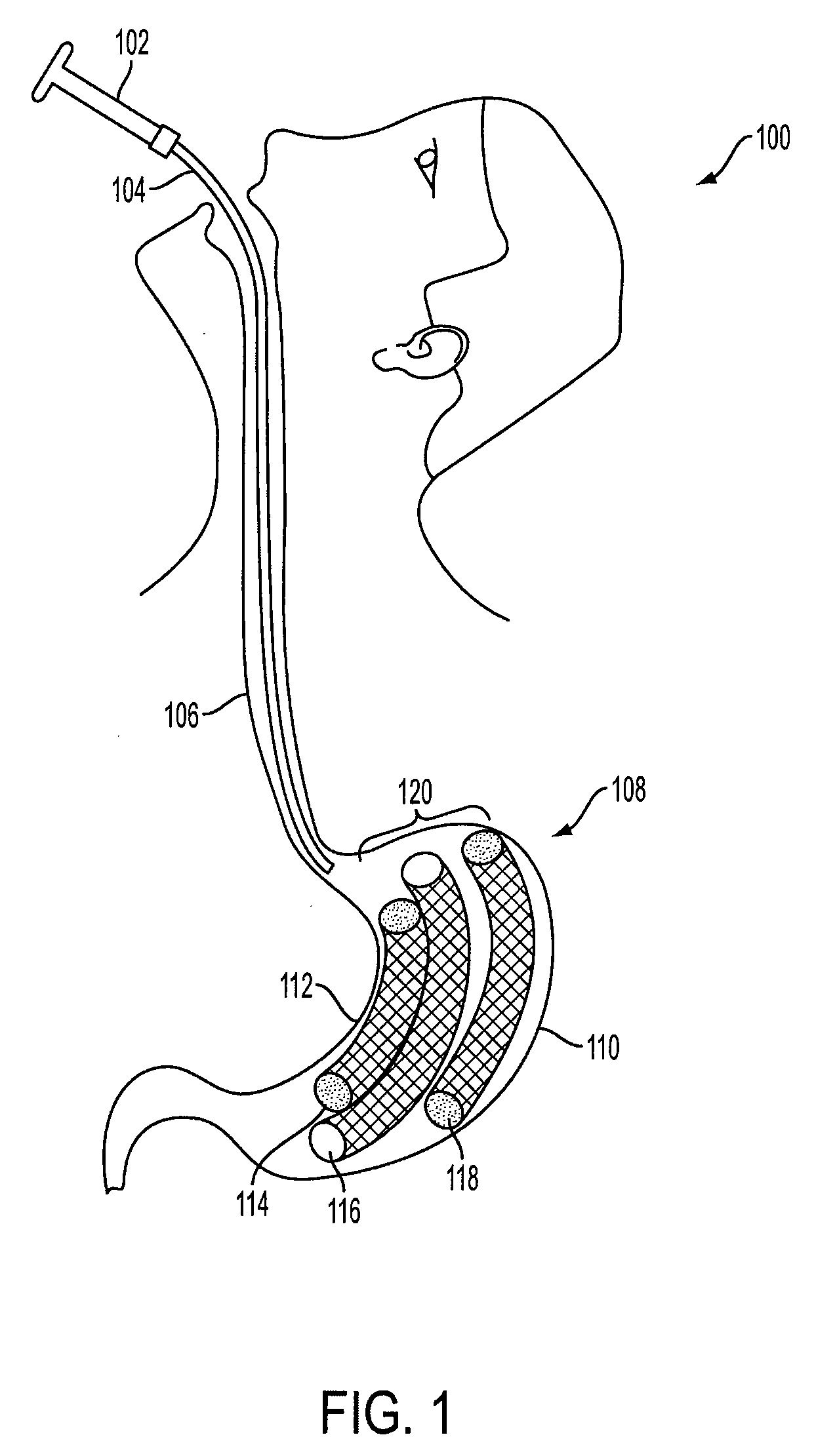 Method and apparatus for treating obesity and controlling weight gain using self-expanding intragastric devices