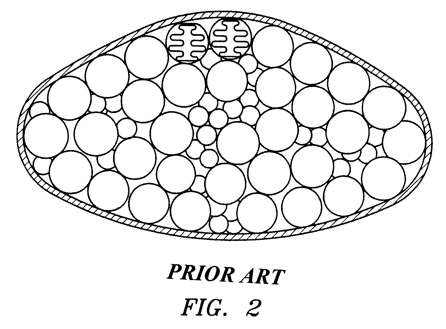 Modulating buttress saline mammary prosthesis