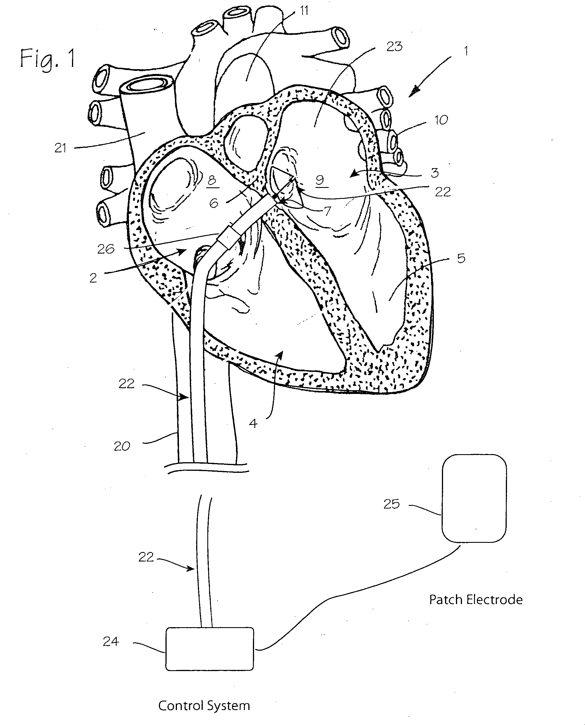 Atrial ablation catheter adapted for treatment of septal wall arrhythmogenic foci and method of use