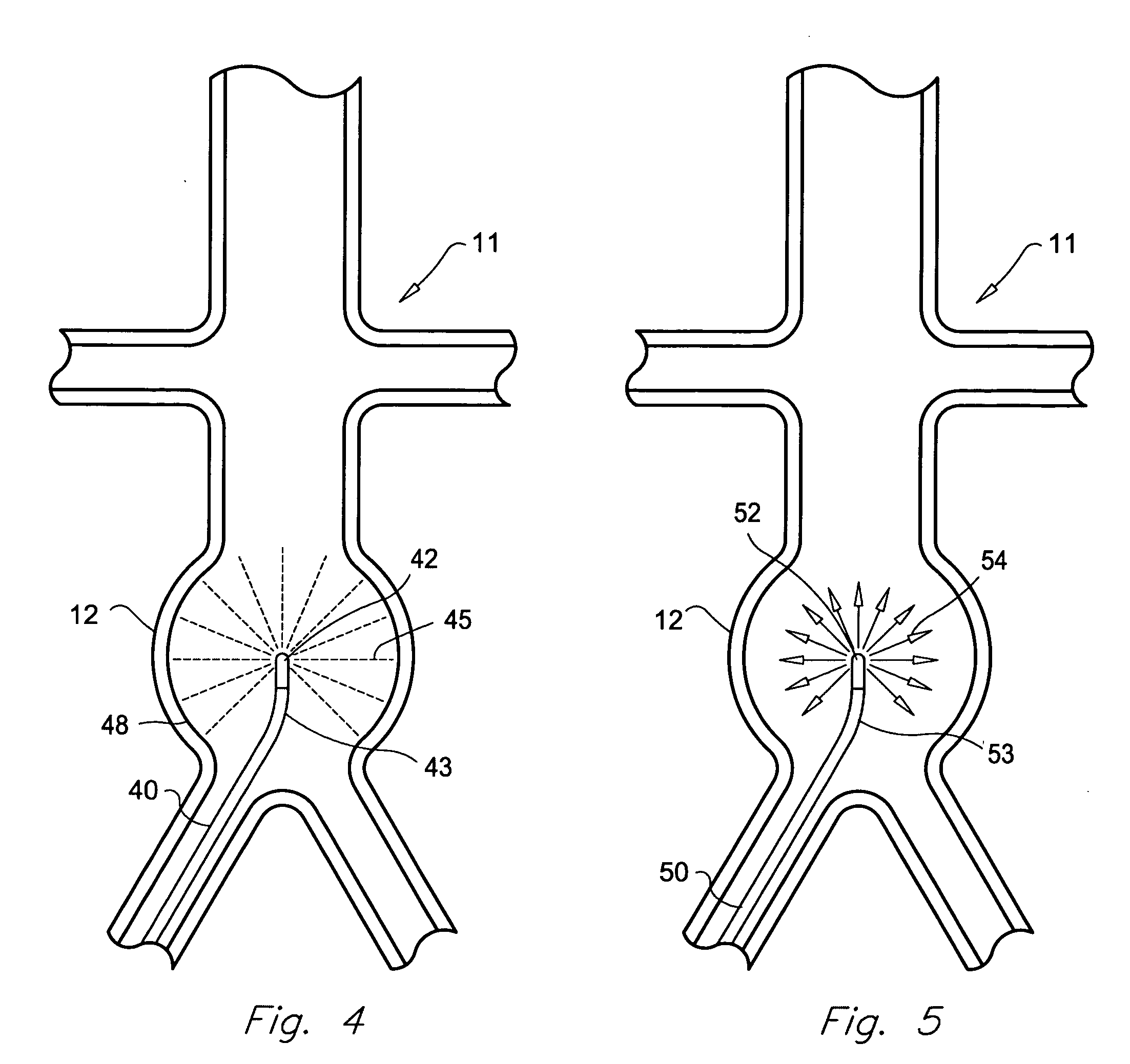 Method for treatment of aneurysms