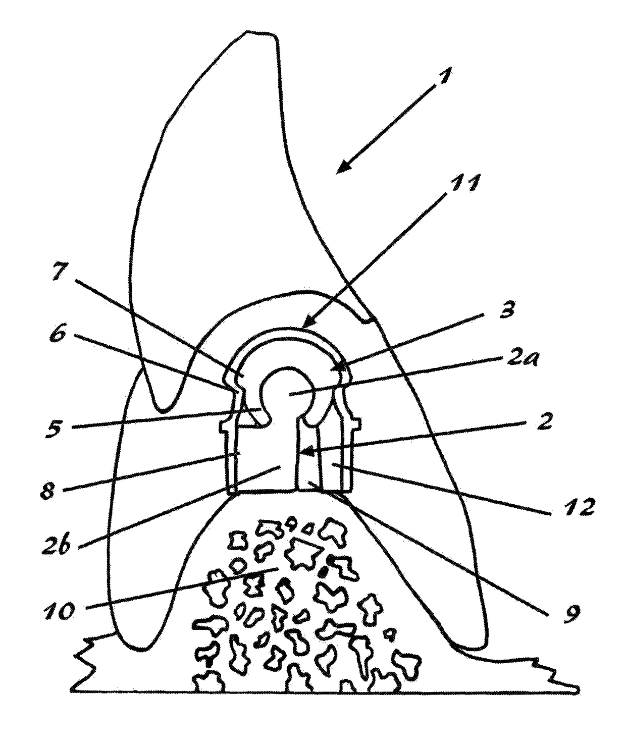 Precision attachment system with indirect retainer