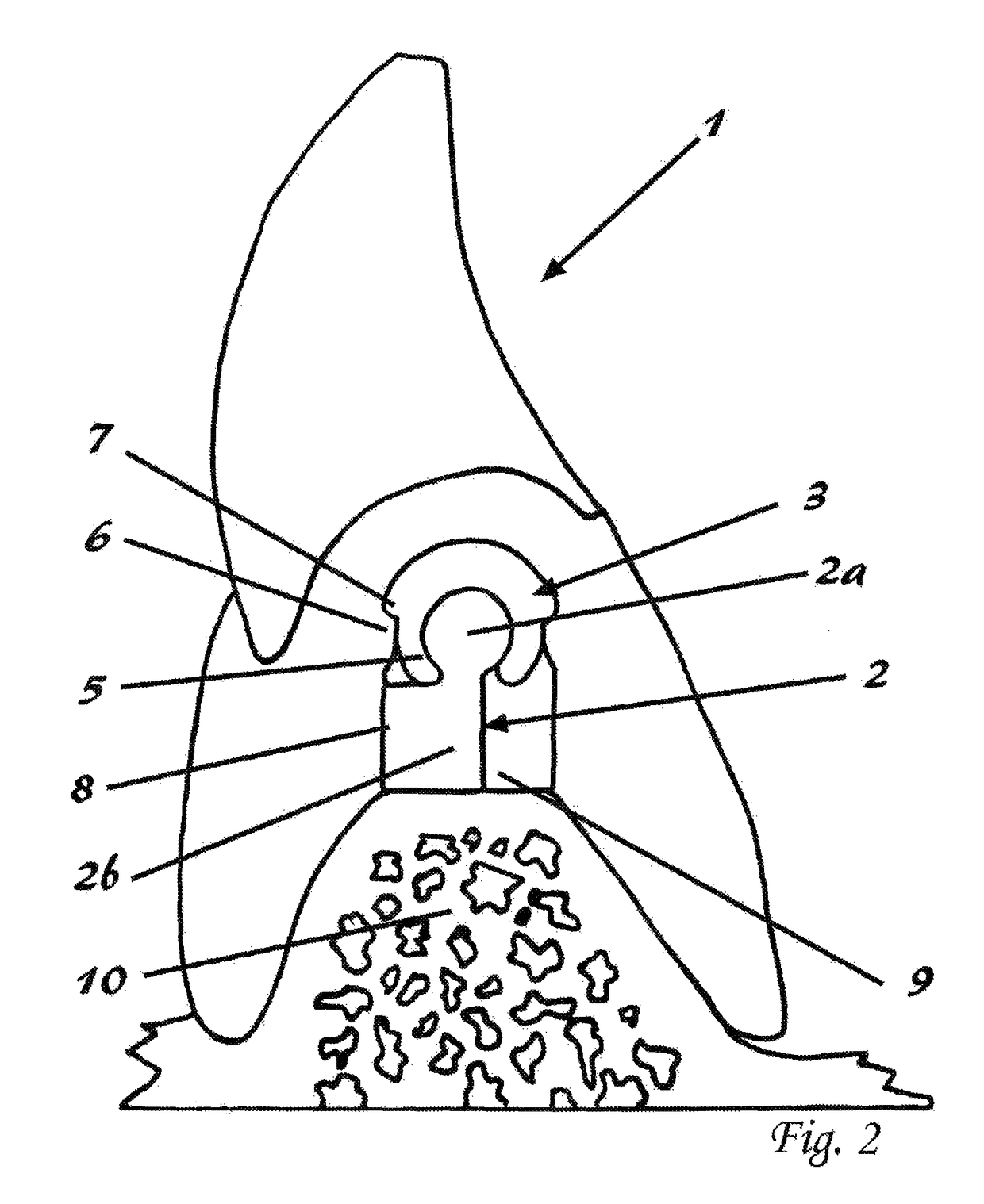 Precision attachment system with indirect retainer