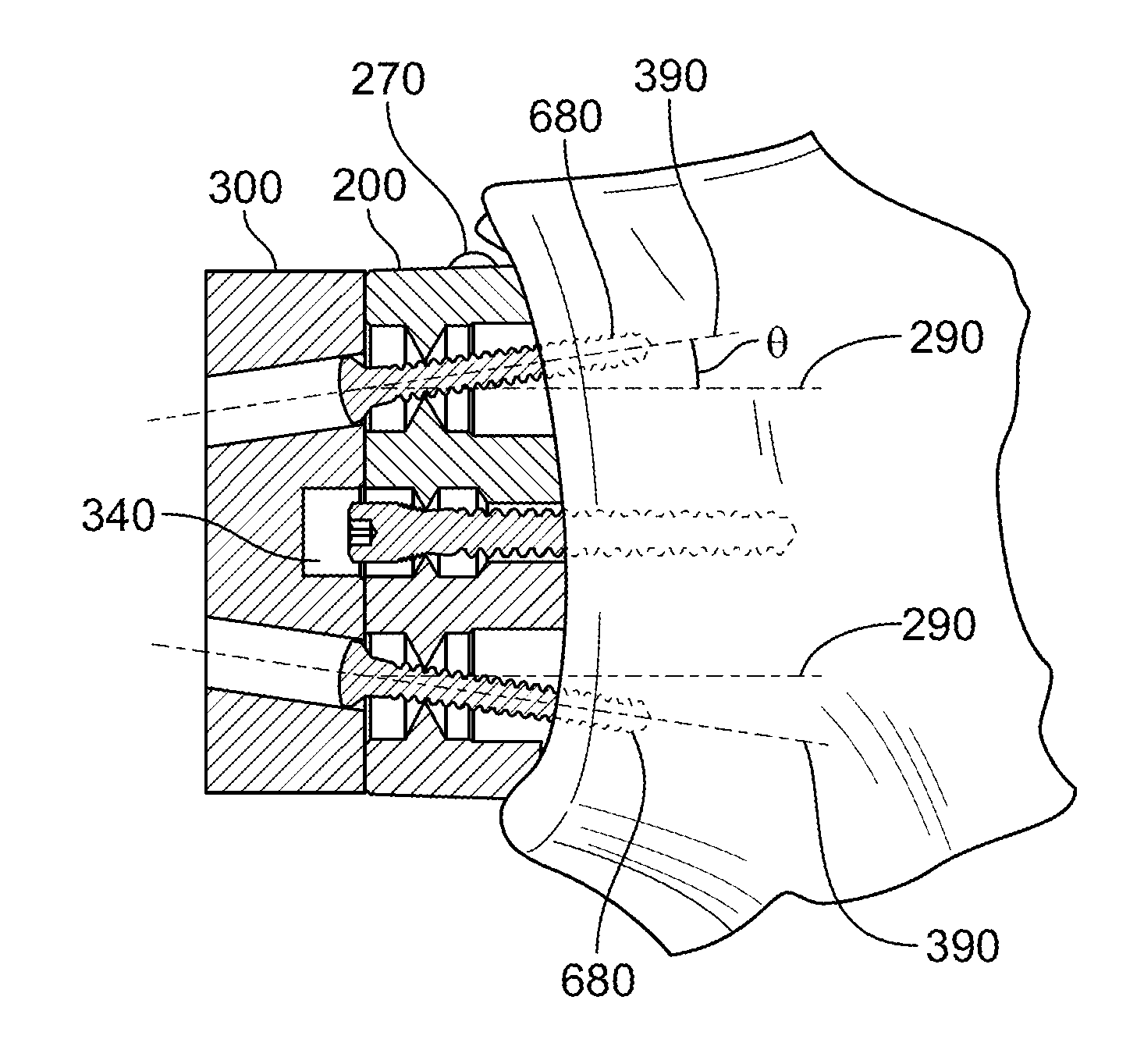 Shape-fit glenoid reaming systems and methods