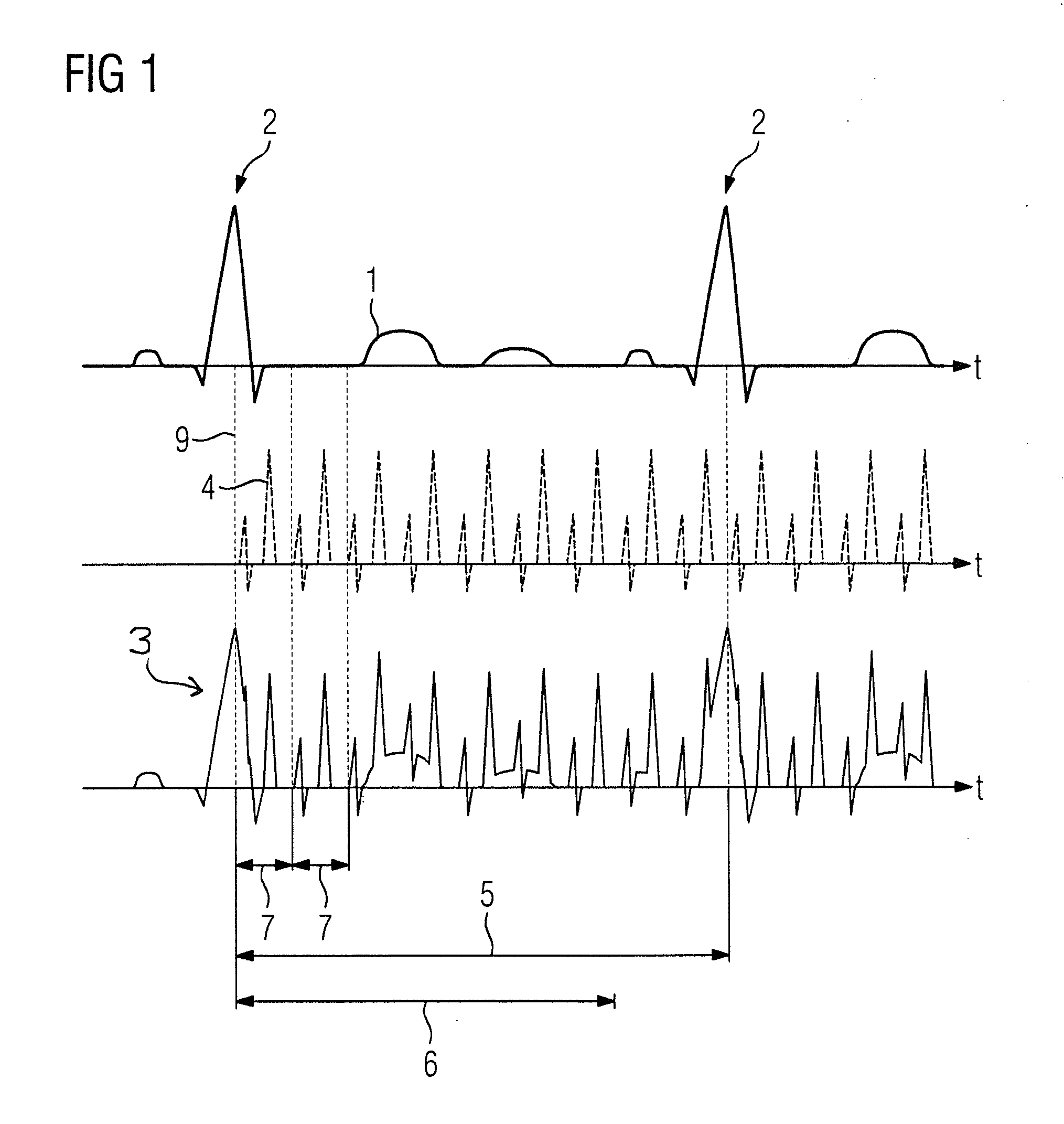 Method and ekg trigger device for correcting an ekg signal in magnetic resonance image acquisition