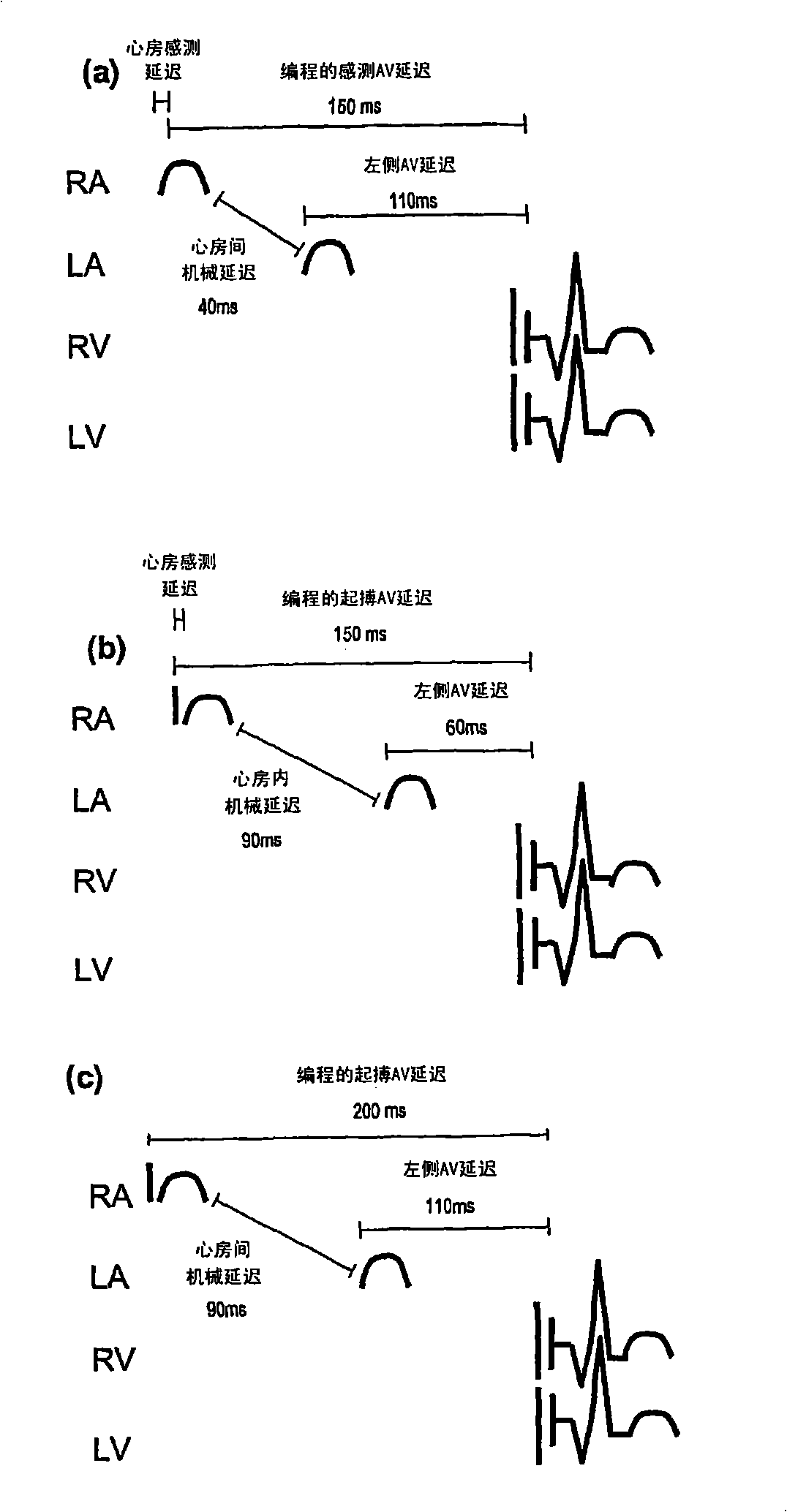 An apparatus and a method for programming a pacemaker
