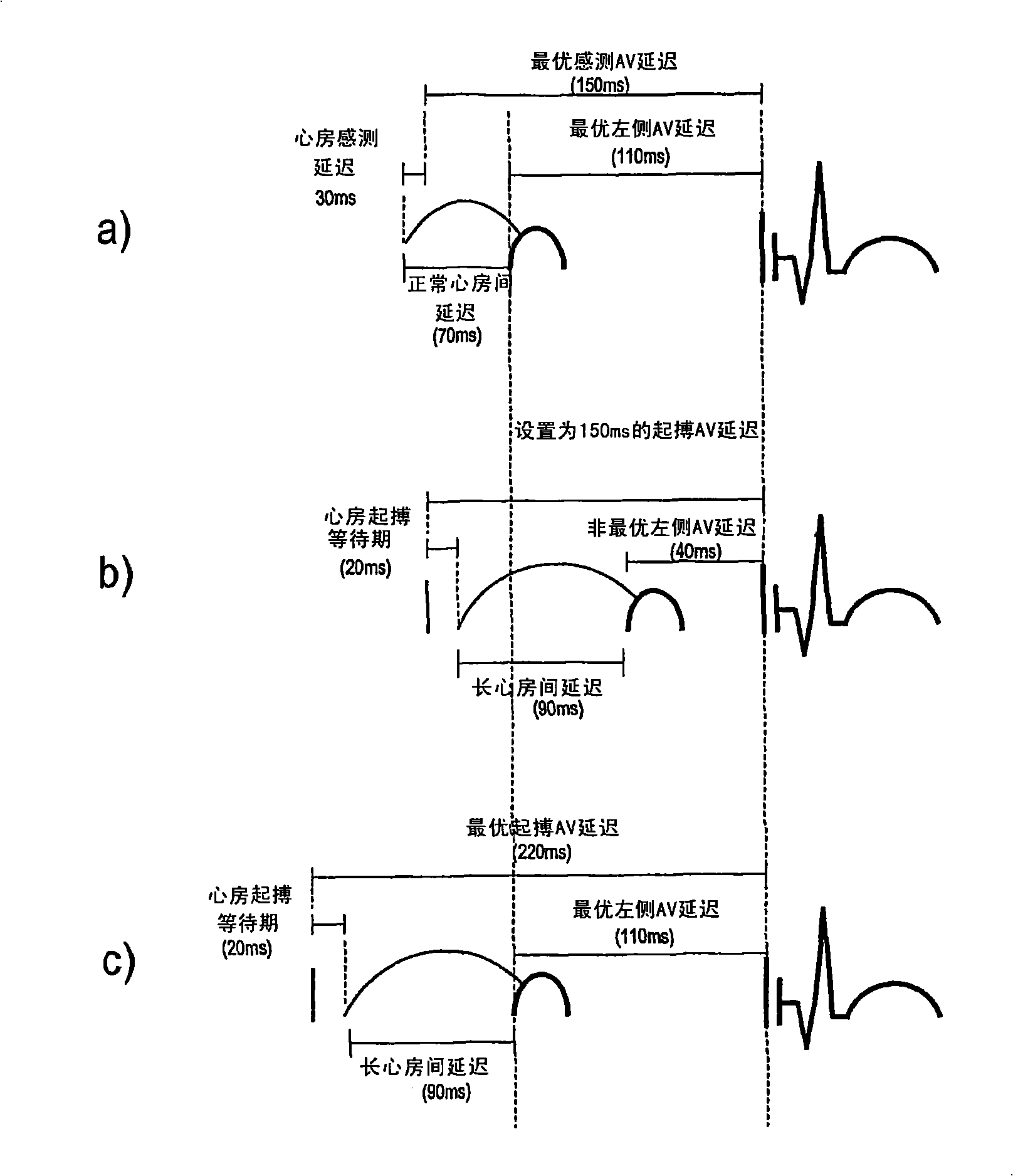 An apparatus and a method for programming a pacemaker