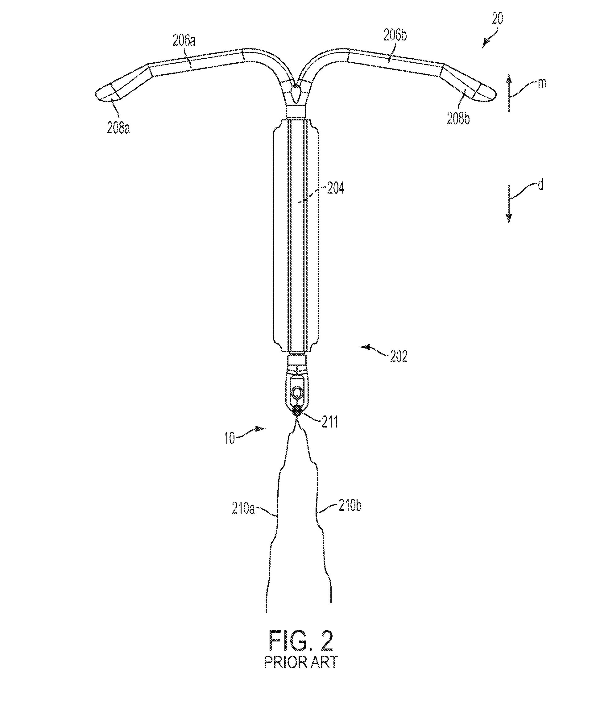 Intraurinary systems, iud insertion devices, and related methods and kits therefor