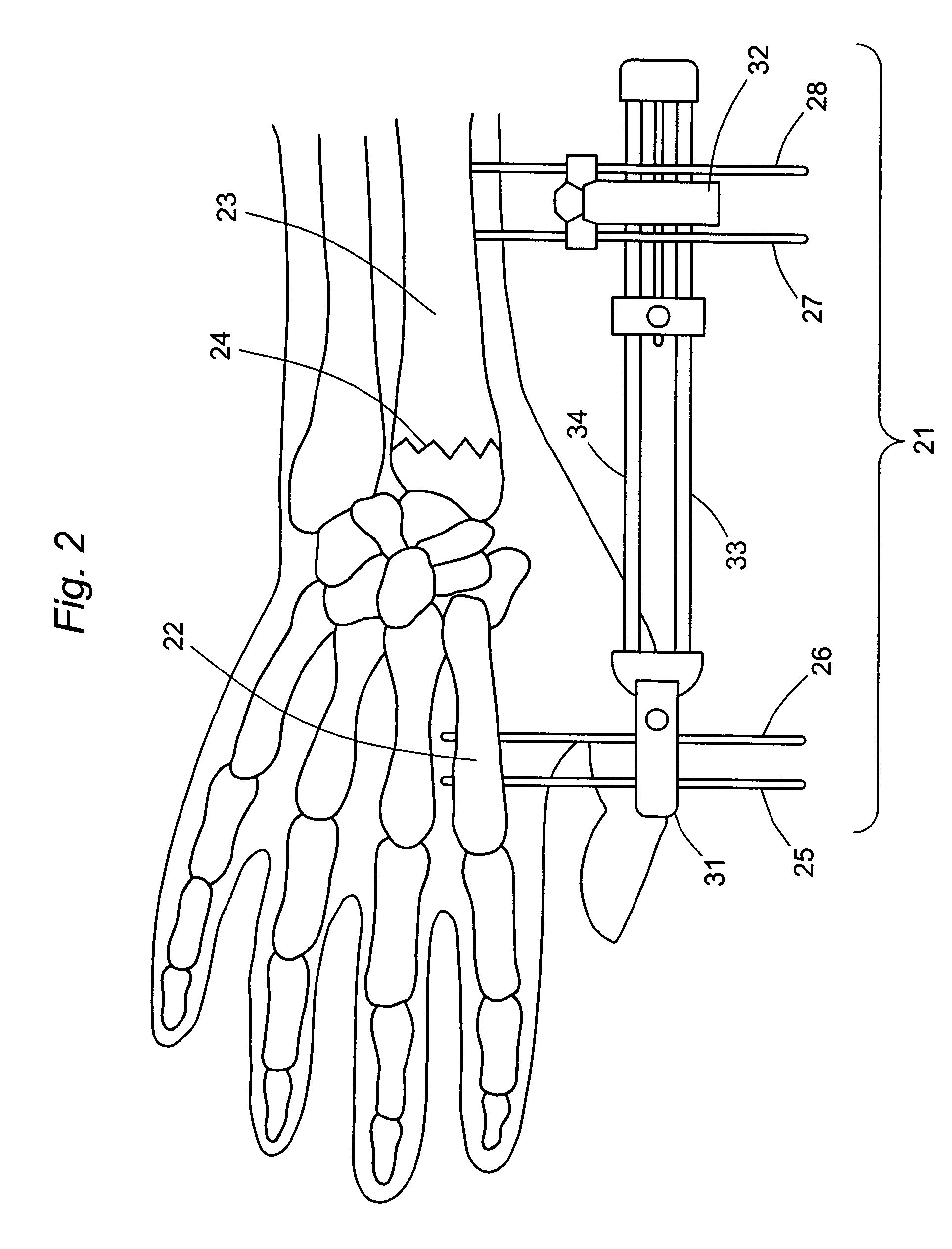 External fixator for Colles' fracture