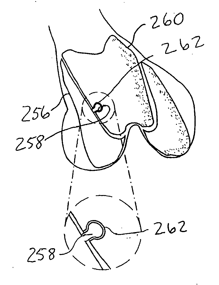 Systems and methods for compartmental replacement in a knee
