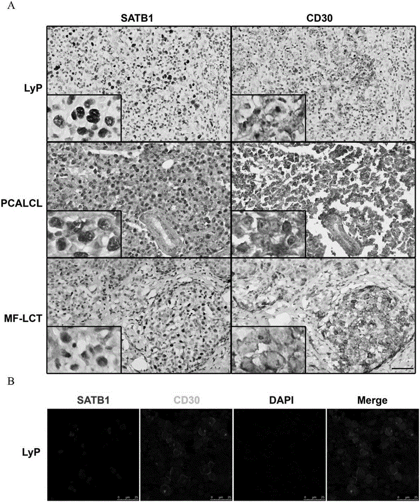 Application of satb1 in the treatment of cutaneous T-cell lymphoma