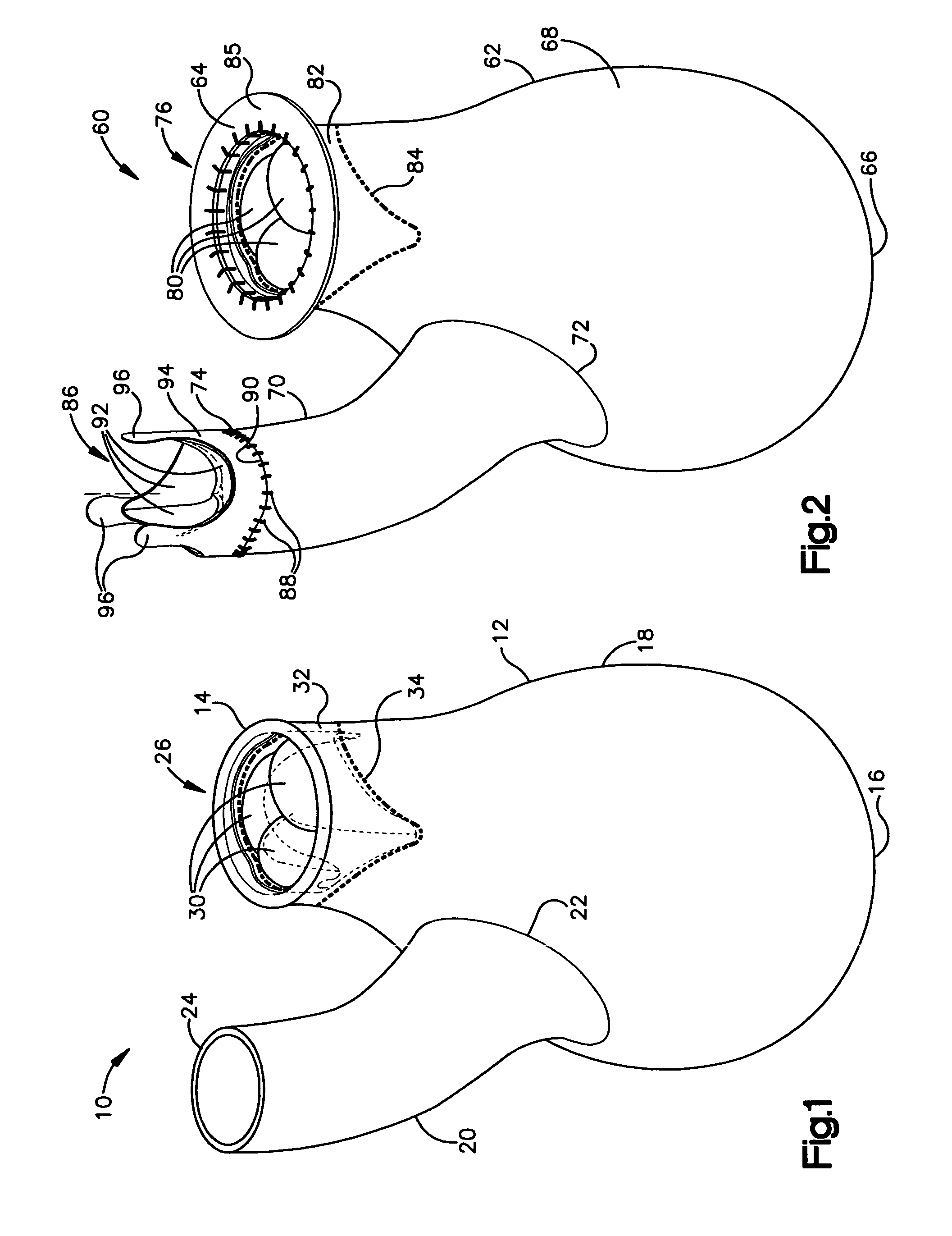 System and method for improving ventricular function