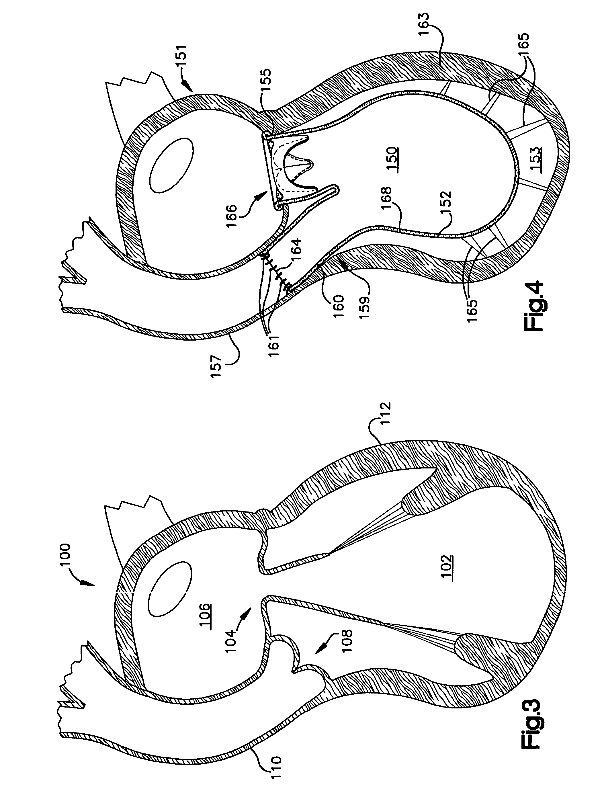 System and method for improving ventricular function