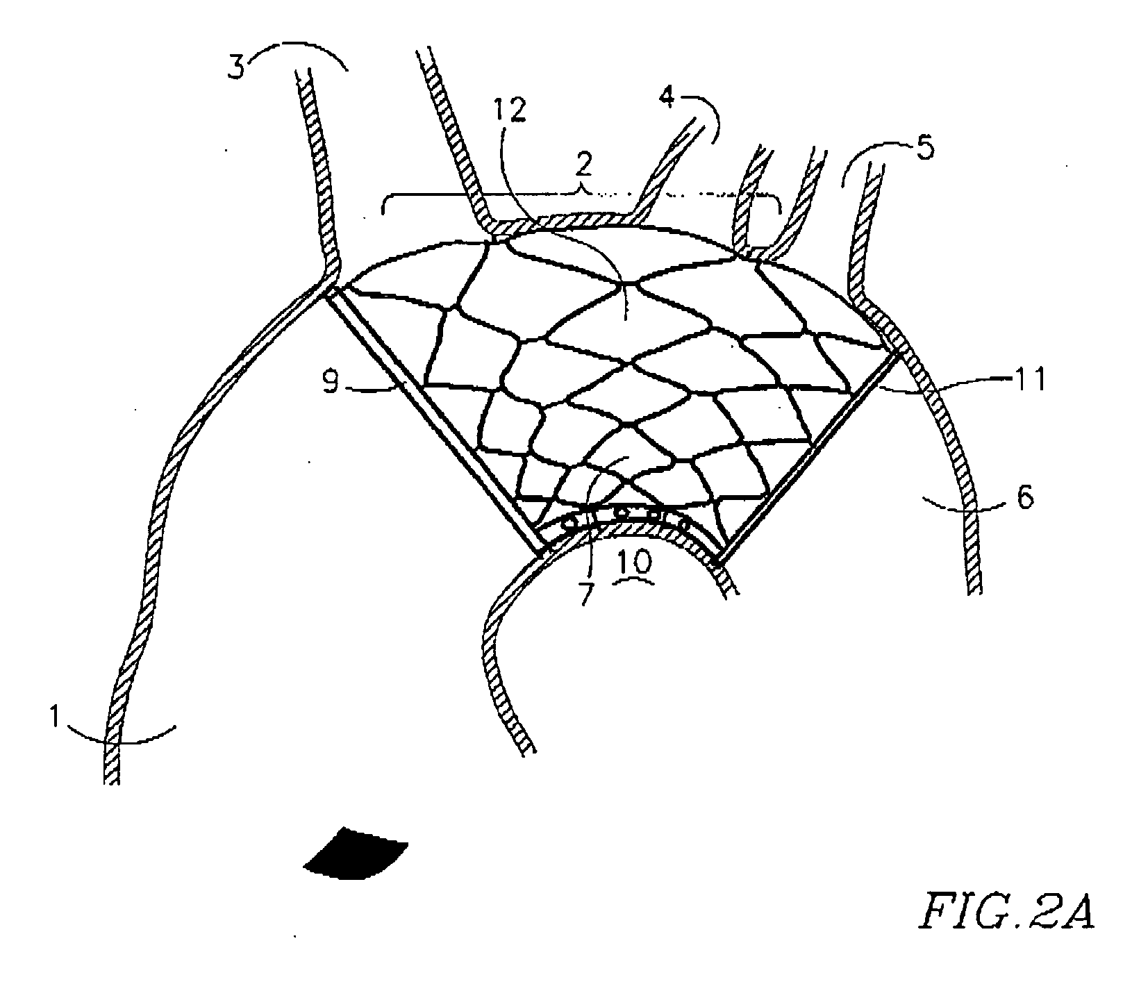 Endovascular device for entrapment of participate matter and method for use